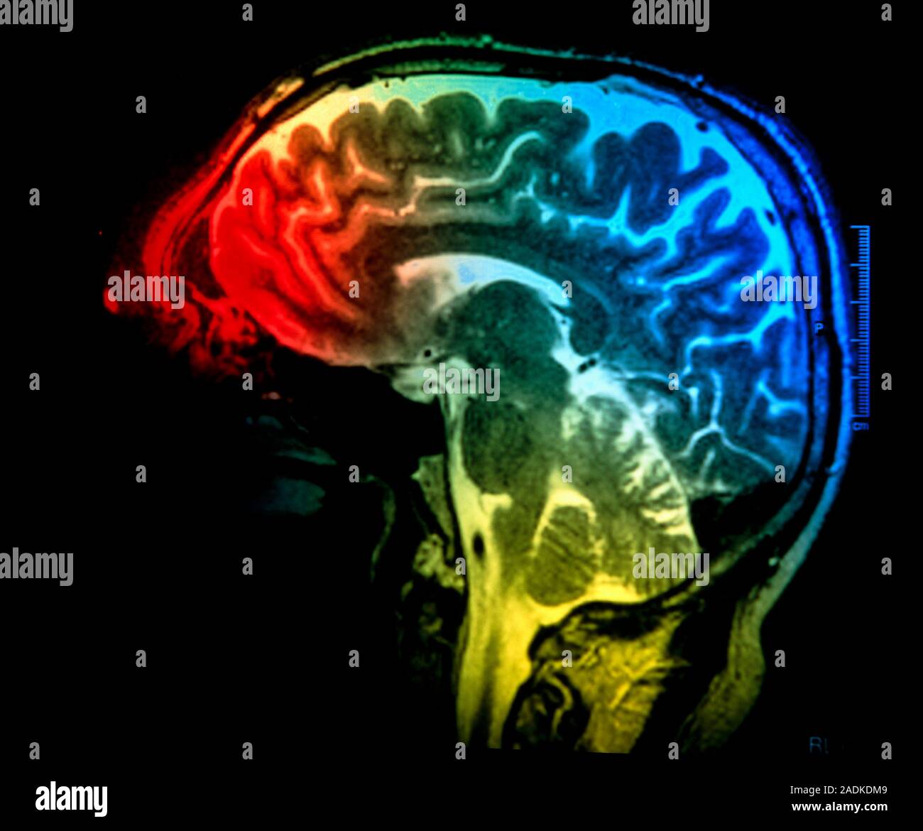 Healthy brain. Coloured magnetic resonance imaging (MRI) scan of a ...