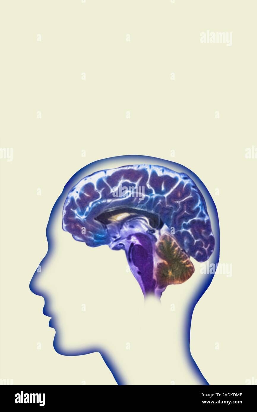 Brain. Coloured magnetic resonance imaging (MRI) scan of a sagittal ...