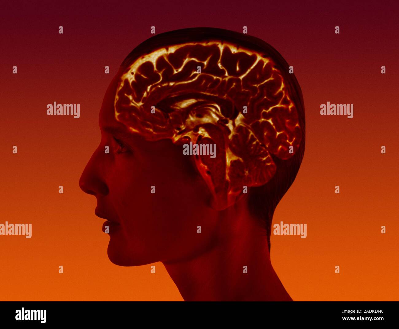 Brain scan. Coloured magnetic resonance imaging (MRI) scan of a ...
