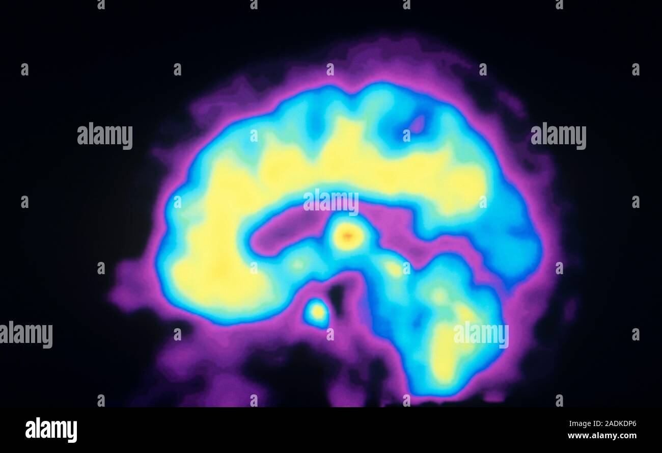 Opioid receptors. Coloured sagittal Positron Emission Tomography (PET) scan showing the normal distribution of opioid receptors in the human brain. Op Stock Photo