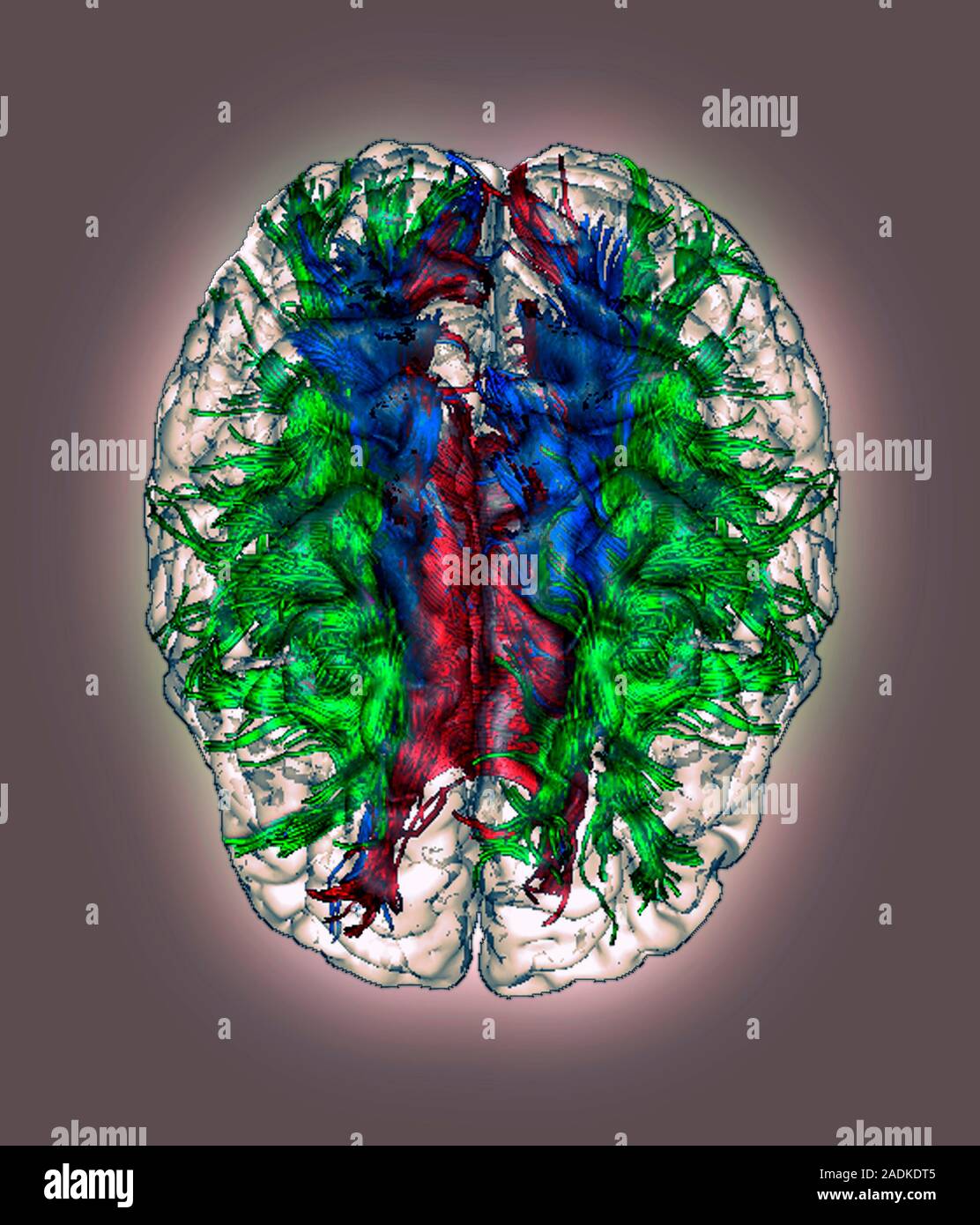 White matter fibres. Coloured 3D diffusion tensor imaging (DTI) scan of ...