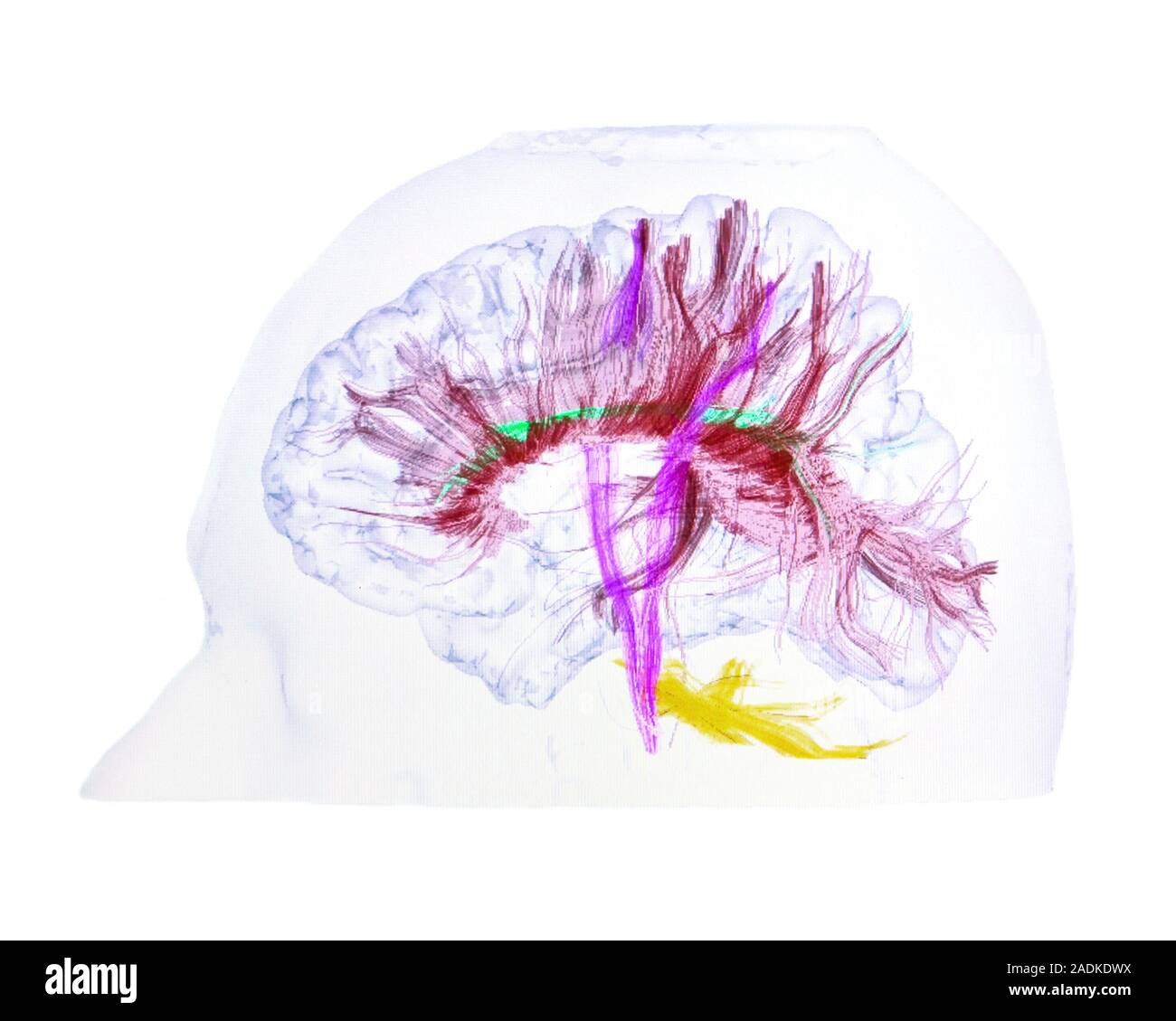 Advanced MRI brain scan. This 3D magnetic resonance imaging (MRI) scan of a normal human head and brain has been produced by the 3T MRI scanner at Neu Stock Photo