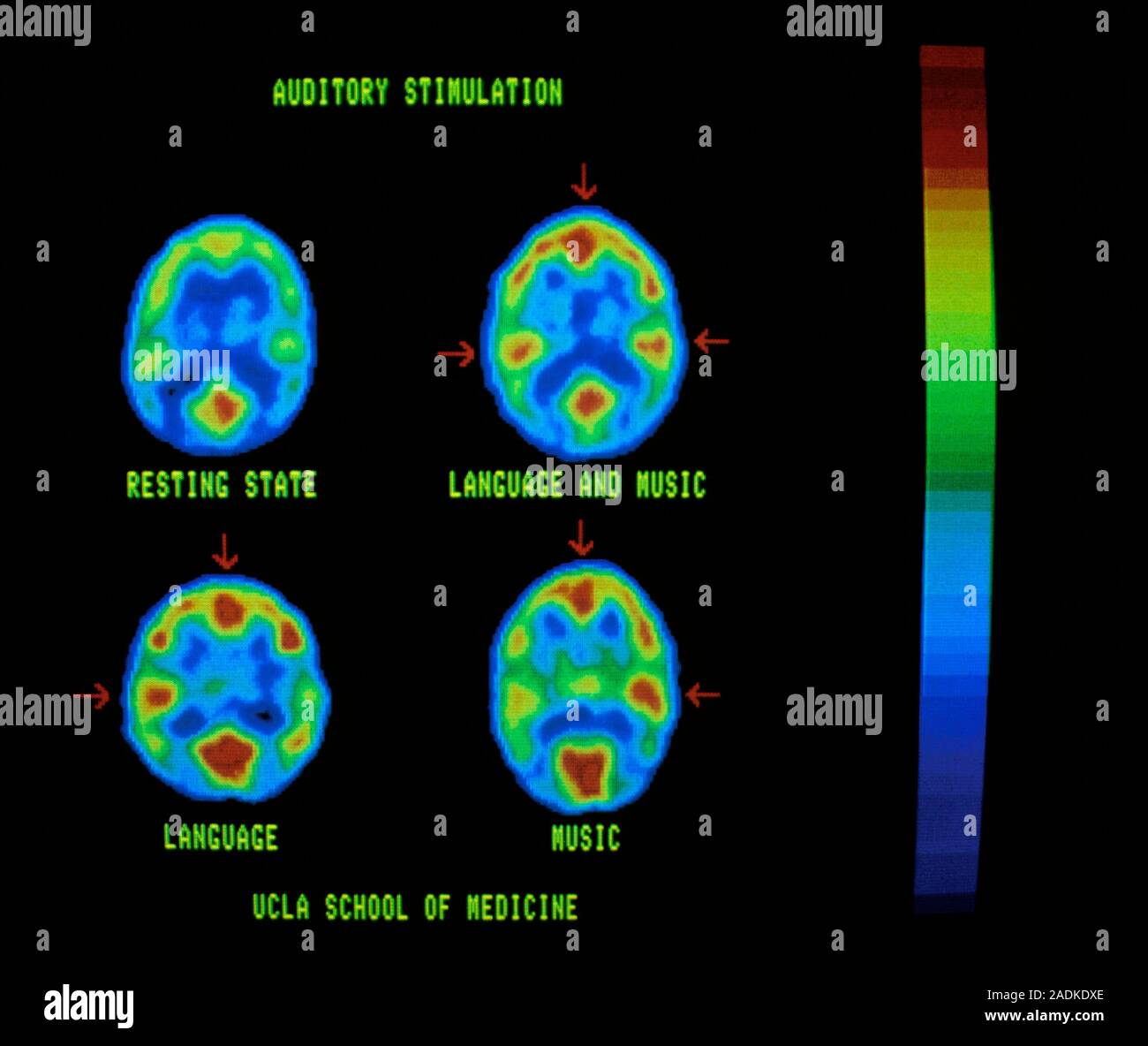 Positron computed tomography (PCT) scans of the brain, showing the ...