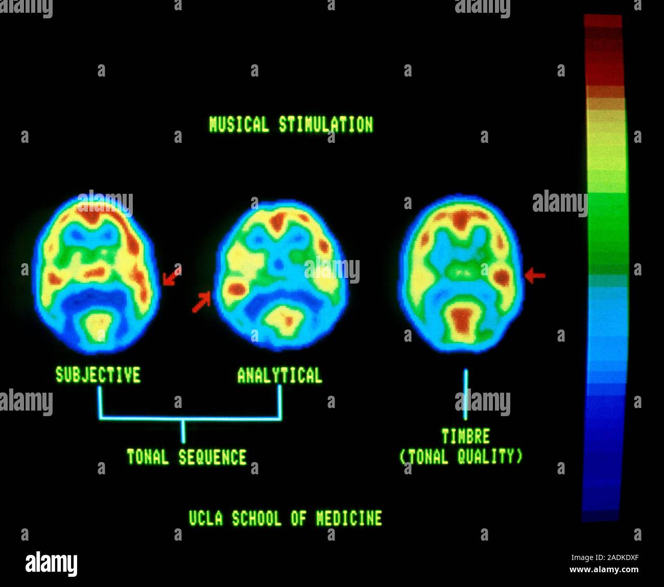 Brain scans made using Positron Computed Tomography (PCT) showing the ...