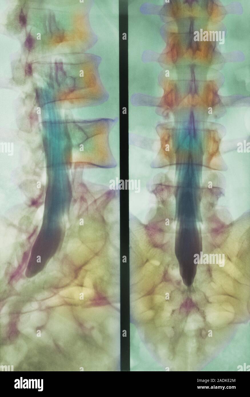 Spinal cord. Coloured myelogram (spinal cord X- ray) of a healthy human