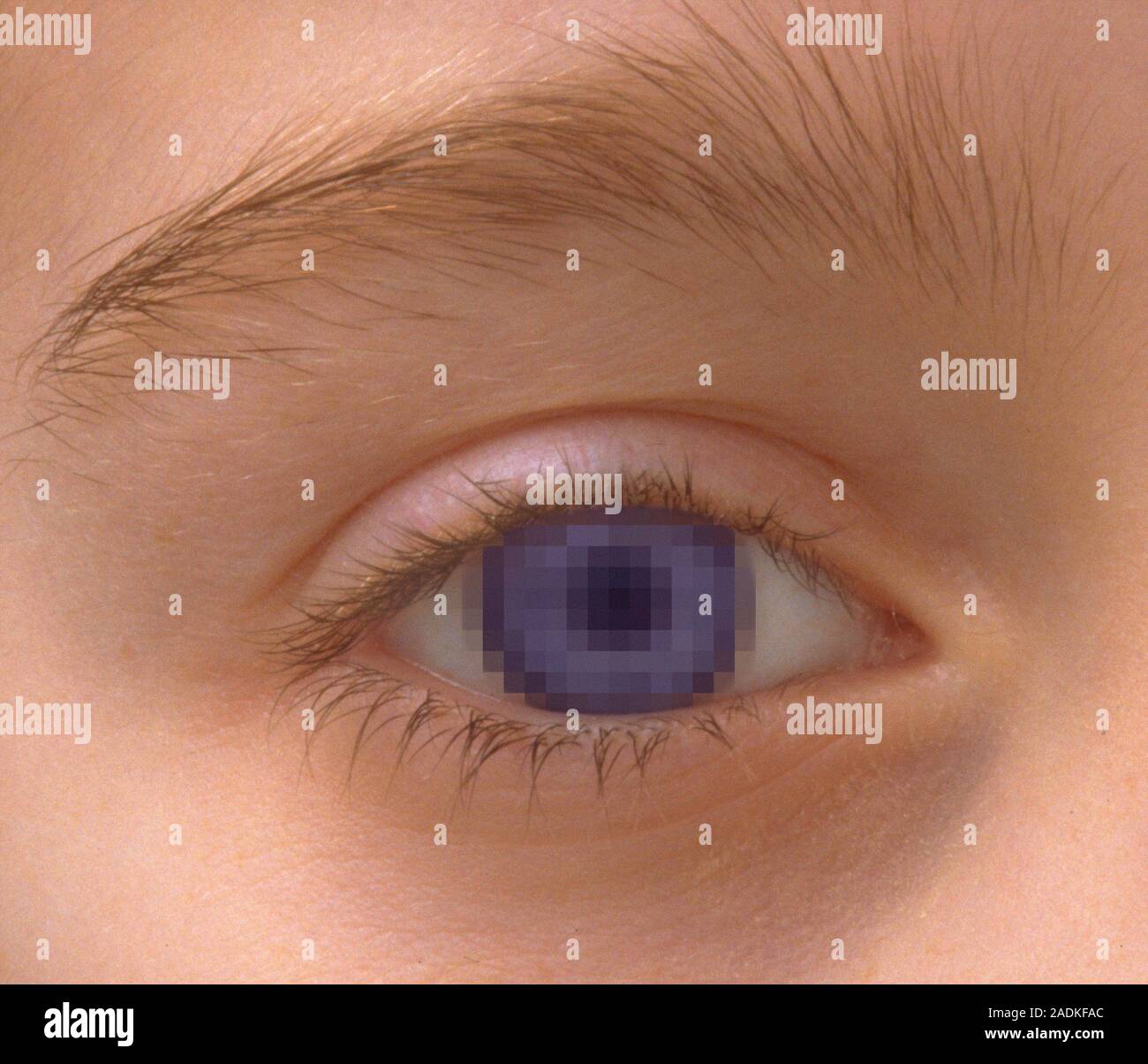 Pixellated eye, computer artwork. This could represent artificial vision or impaired sight. Stock Photo