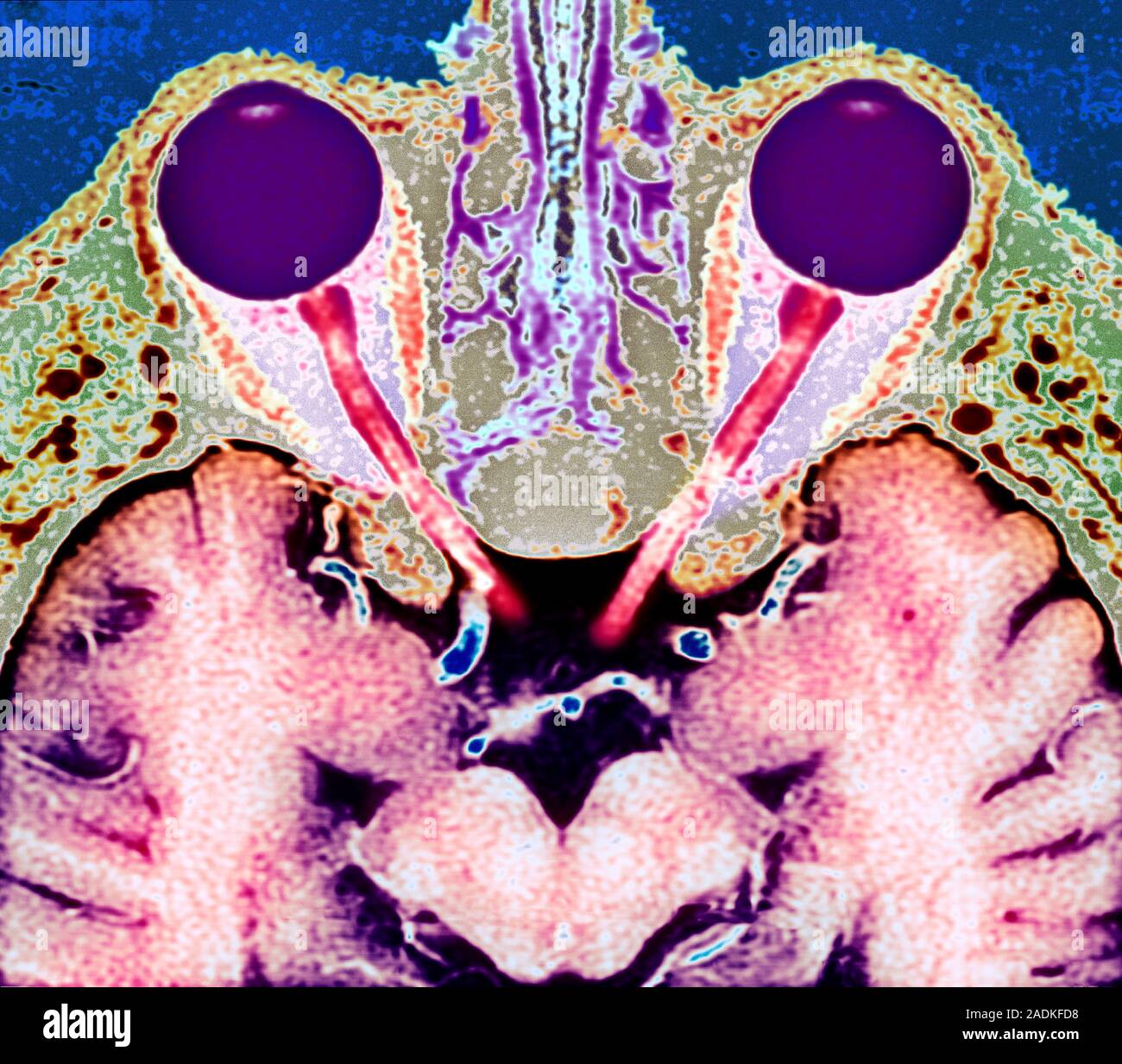 Vision and the brain. Coloured Magnetic Resonance Imaging (MRI) scan of ...