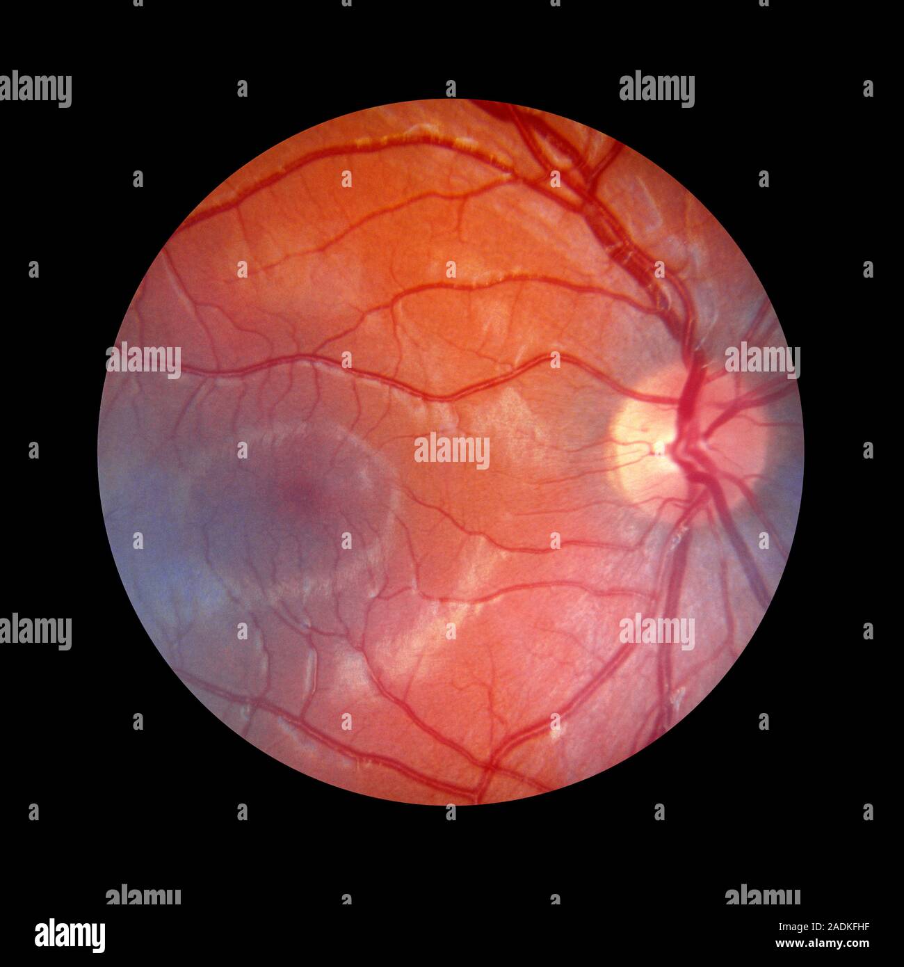 Photo Rétine Fundus camera image of the retina of a normal eye, showing the ...