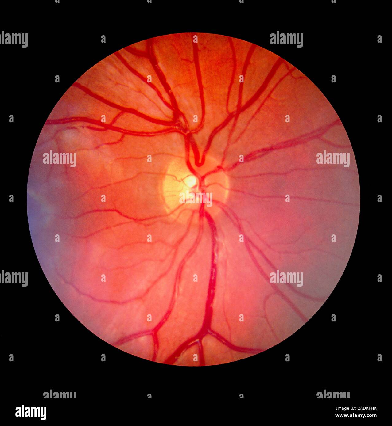 Photo Rétine Fundus camera image of the retina of a normal eye, showing the ...