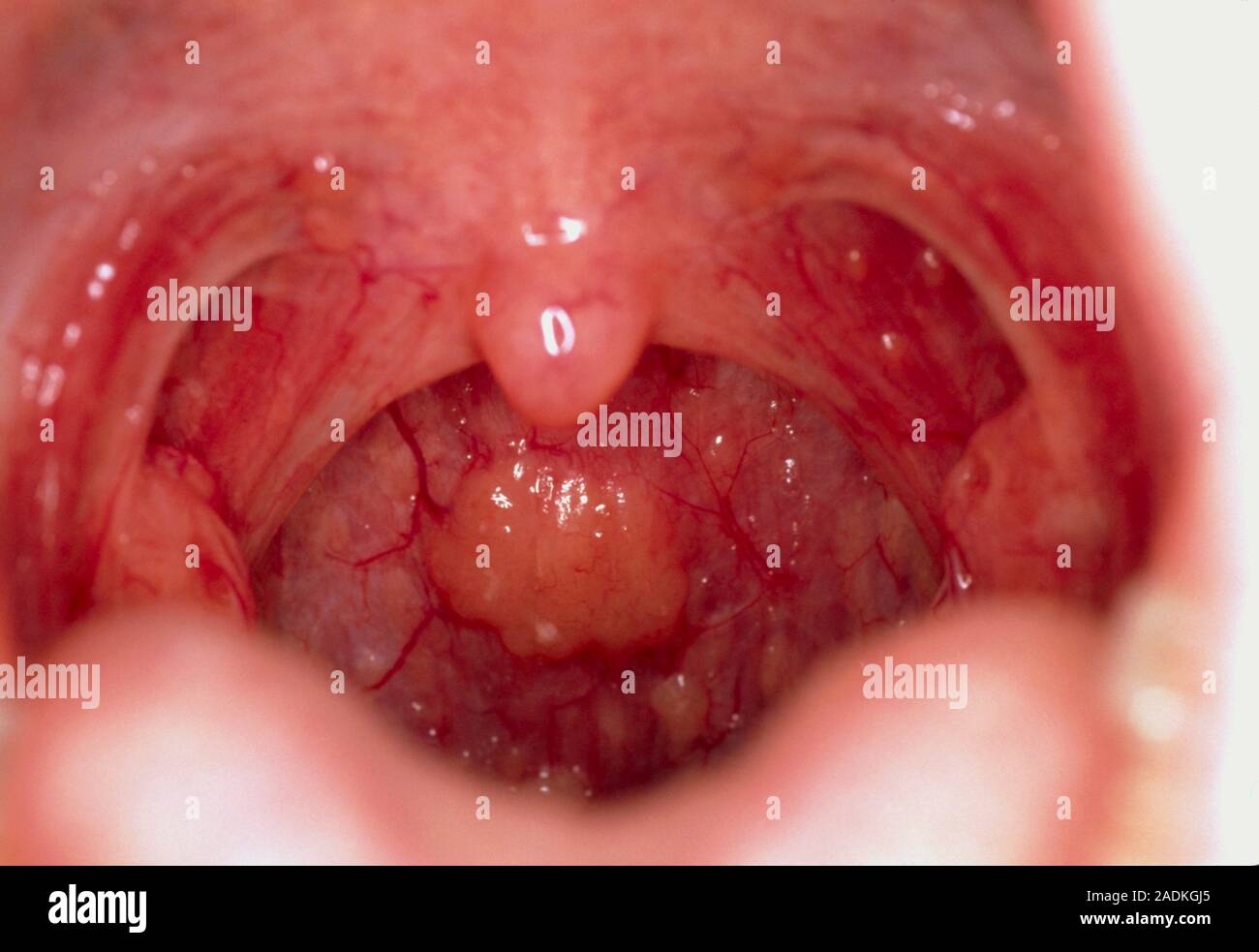 Throat lymphoid tissue. Close-up of a patch of lymphoid tissue on the  throat (pharynx) of a healthy 10-year-old boy. Part of the immune system,  lympho Stock Photo - Alamy