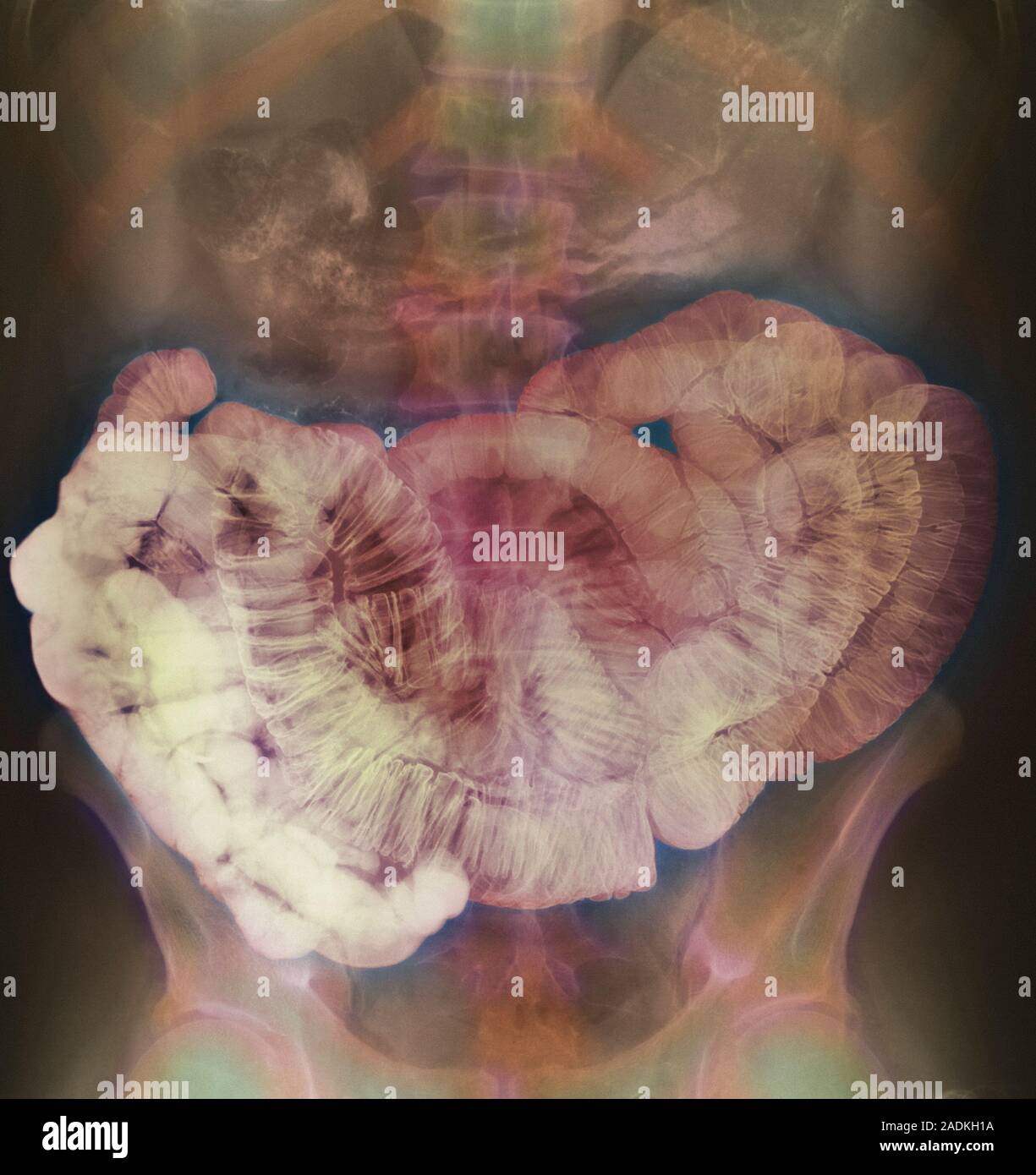Small intestine. Coloured barium X-ray of the abdomen showing a healthy ...