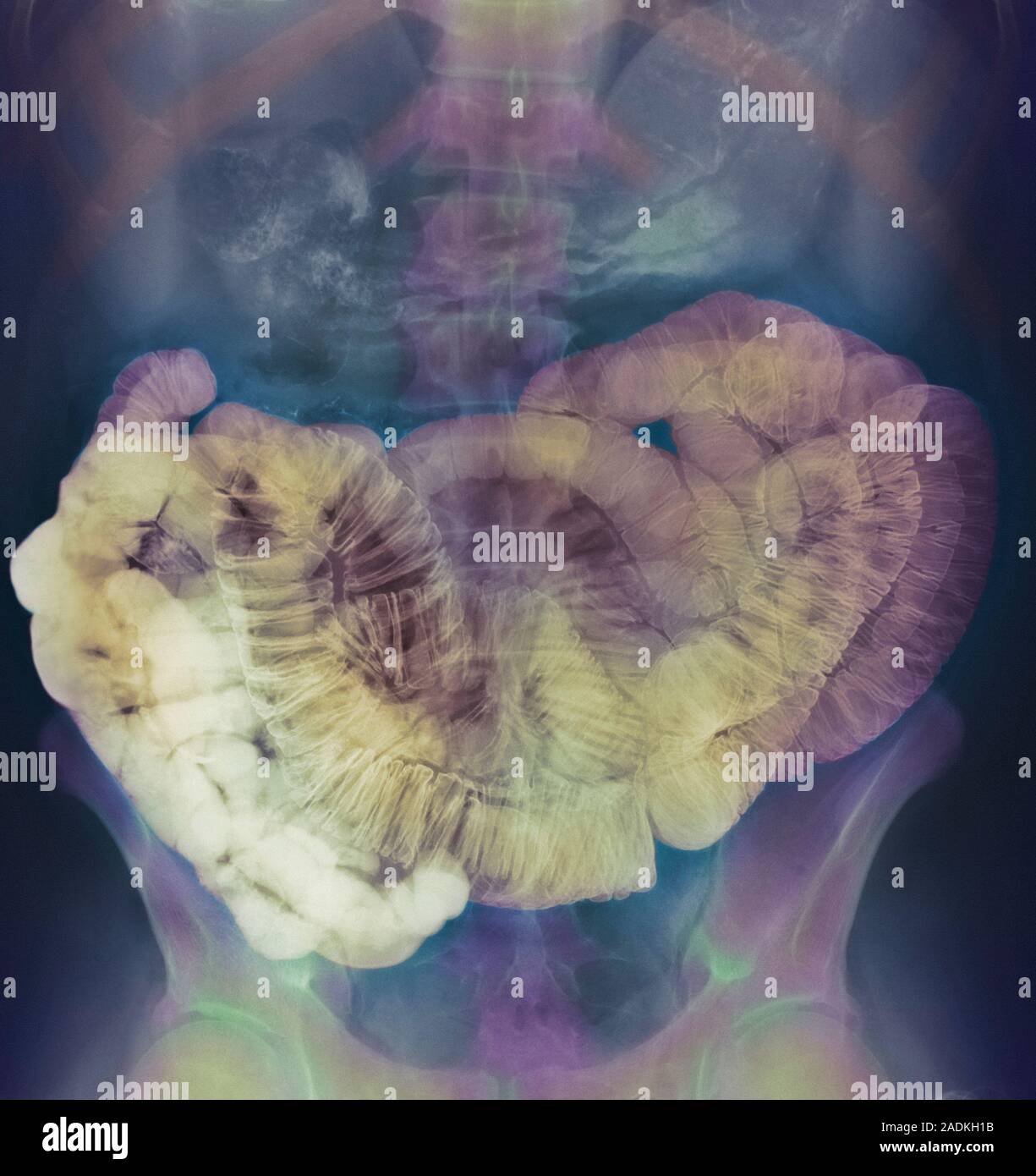 Small intestine. Coloured barium X-ray of the abdomen showing a healthy