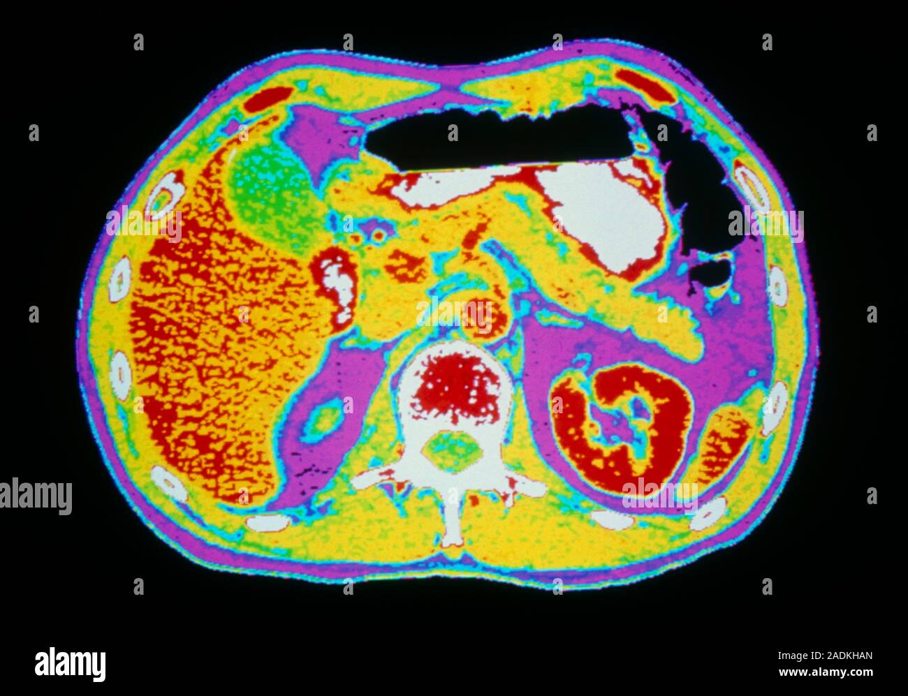 False-colour computed X-ray tomography (CT) scan of an axial section ...
