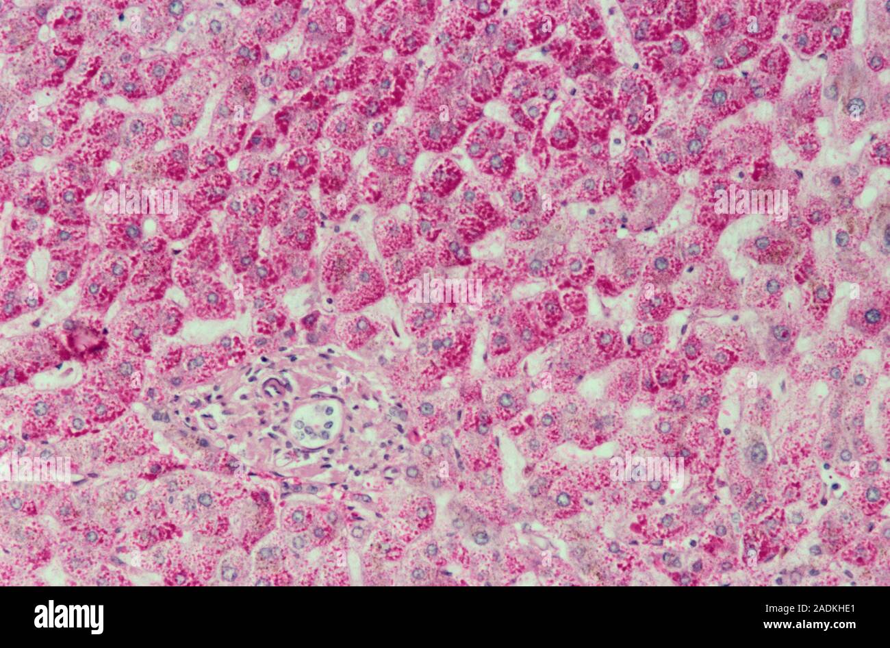 Иммунные клетки печени. Liver Cell. Ямочные клетки печени. Печеночно-клеточная аденома. Liver Hystology Cells.