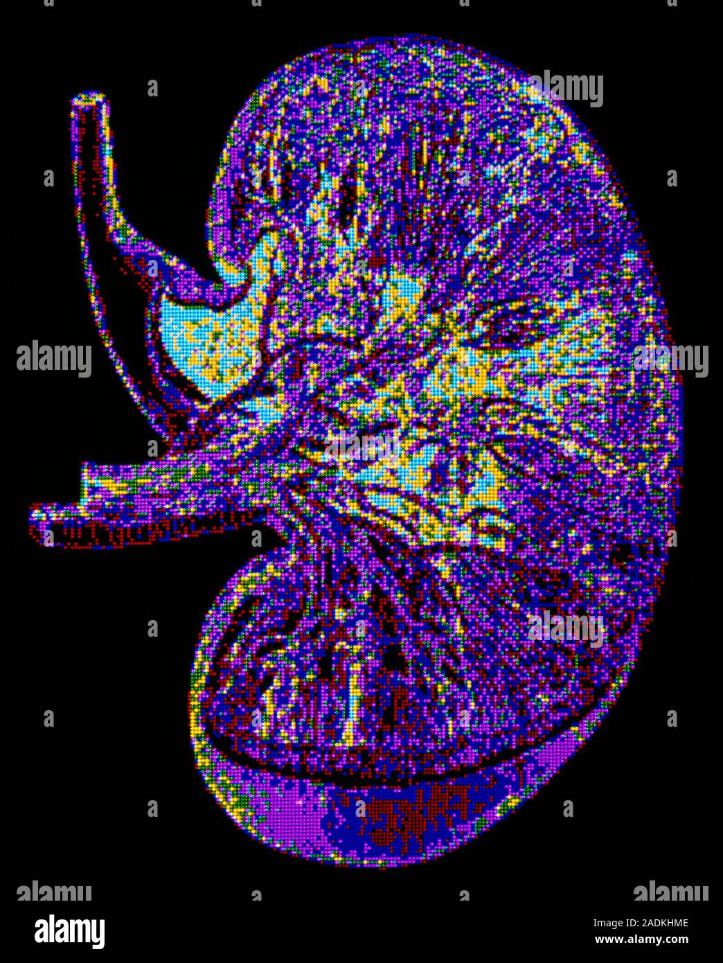 Kidney. Computer graphic image showing a normal human kidney. The two