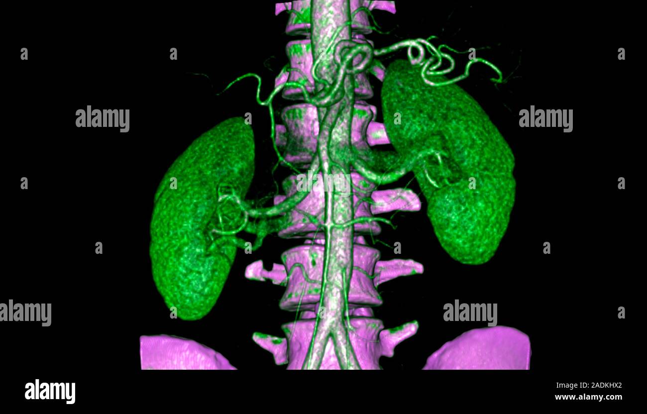 Kidneys, CT scan. Coloured 3D computed tomography (CT) scan of kidneys
