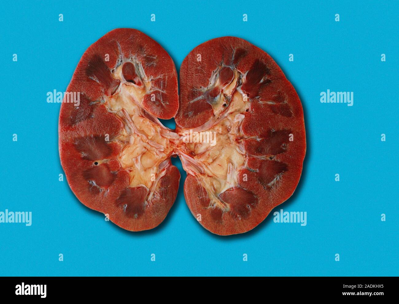 Normal kidney, gross specimen. Kidneys are part of the urinary system