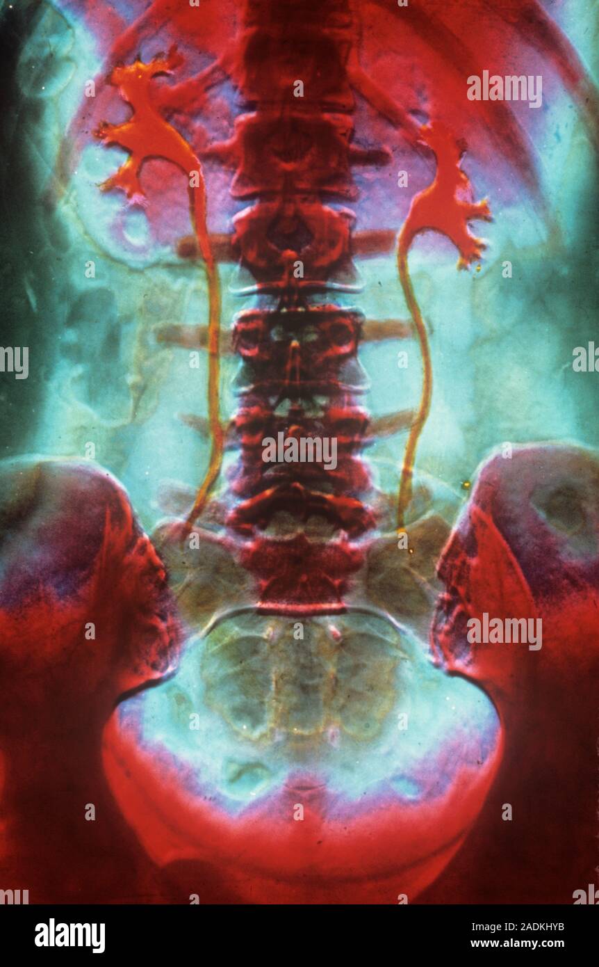 False-colour intravenous pyelogram (IVP), an X-ray image of the human ...