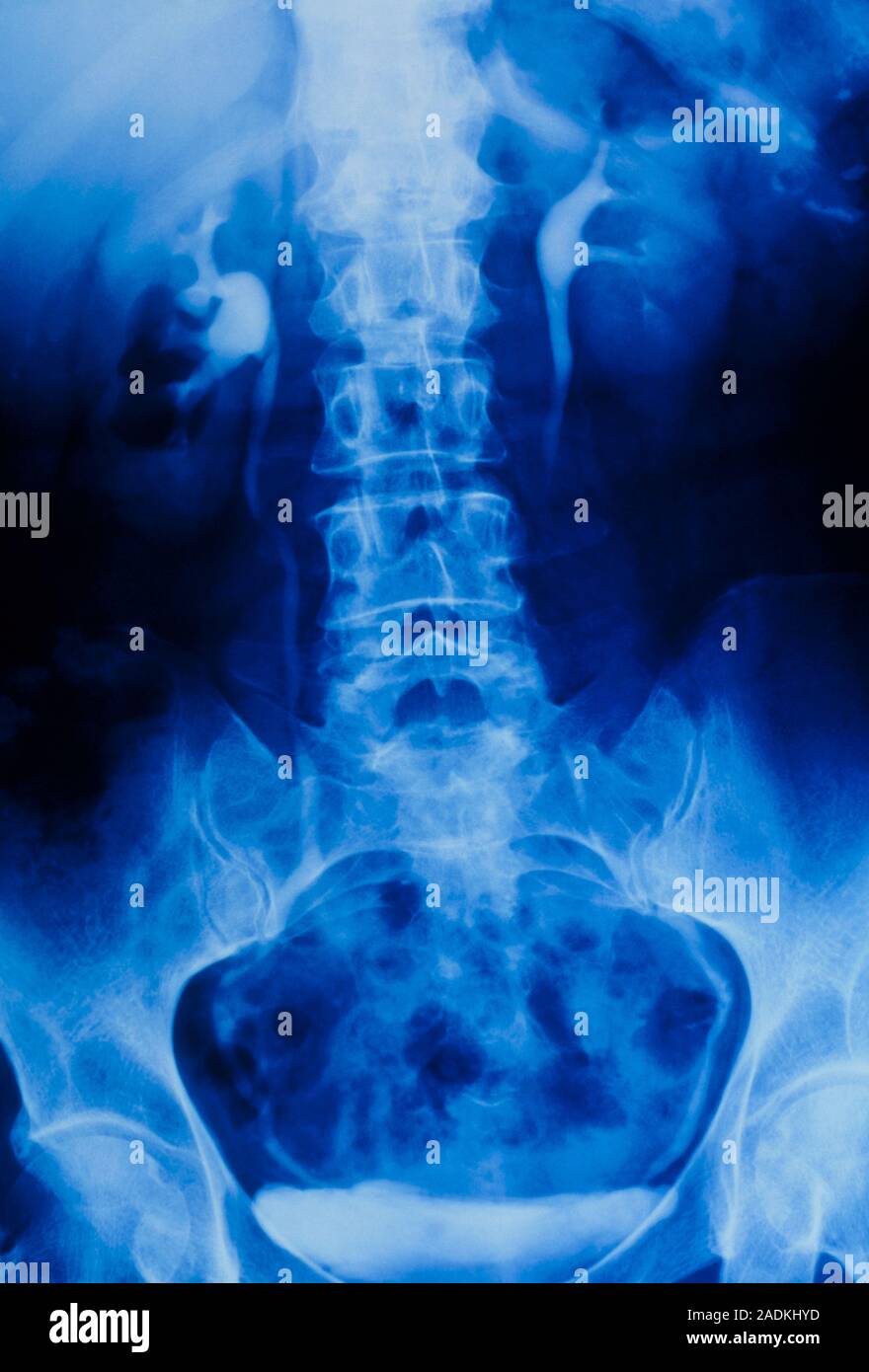 Normal intravenous urogram (IVU), an X-ray image of the human abdominal ...