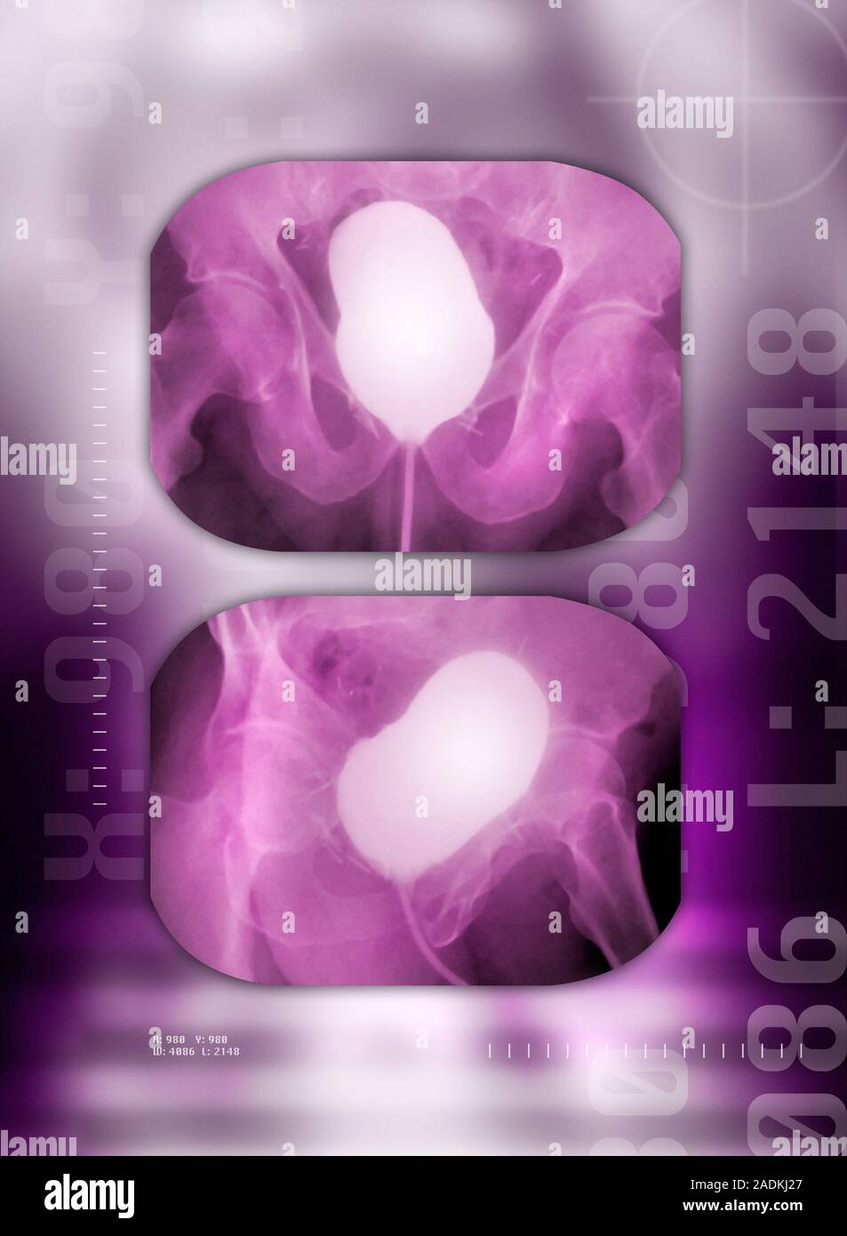 Healthy bladder, coloured cystogram X-ray. Cystography is a diagnostic ...