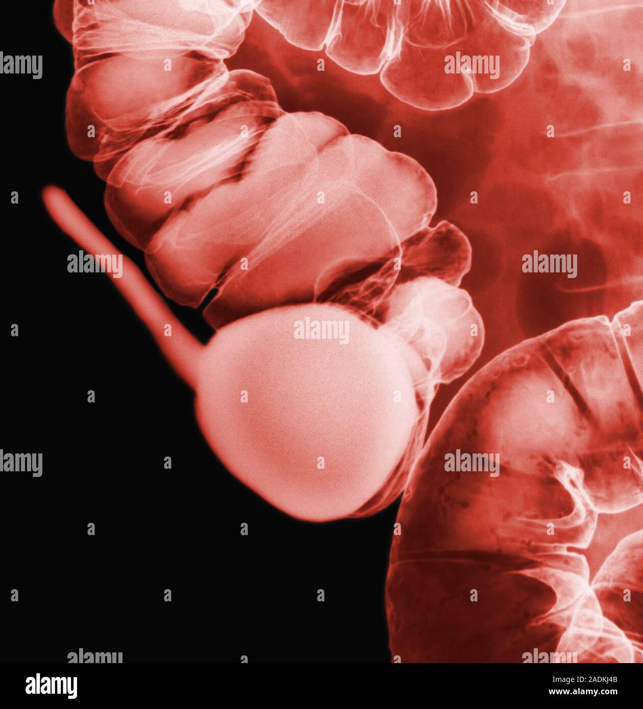 Healthy appendix. Coloured X-ray of the human appendix and colon (large ...