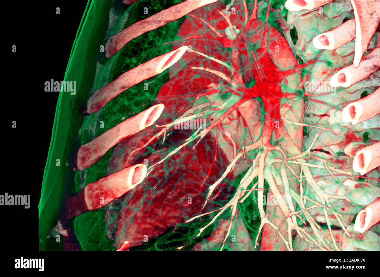 Chest, CT scan. Coloured 3D computed tomography (CT) scan of a chest