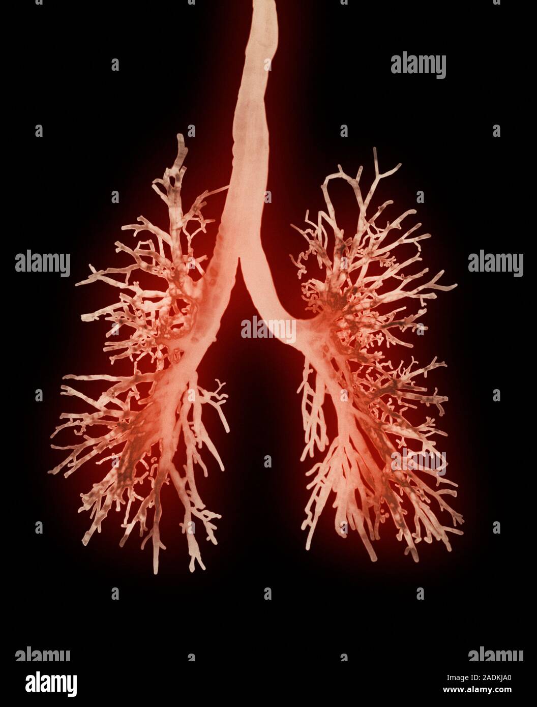 Lung airways. Coloured Xray of the airways (red) of the lungs (not