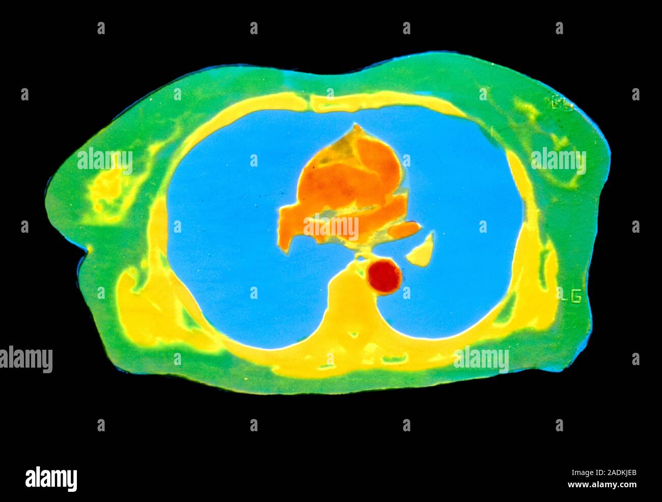 False-colour computed tomography (CT) X-ray scan through the chest of a ...