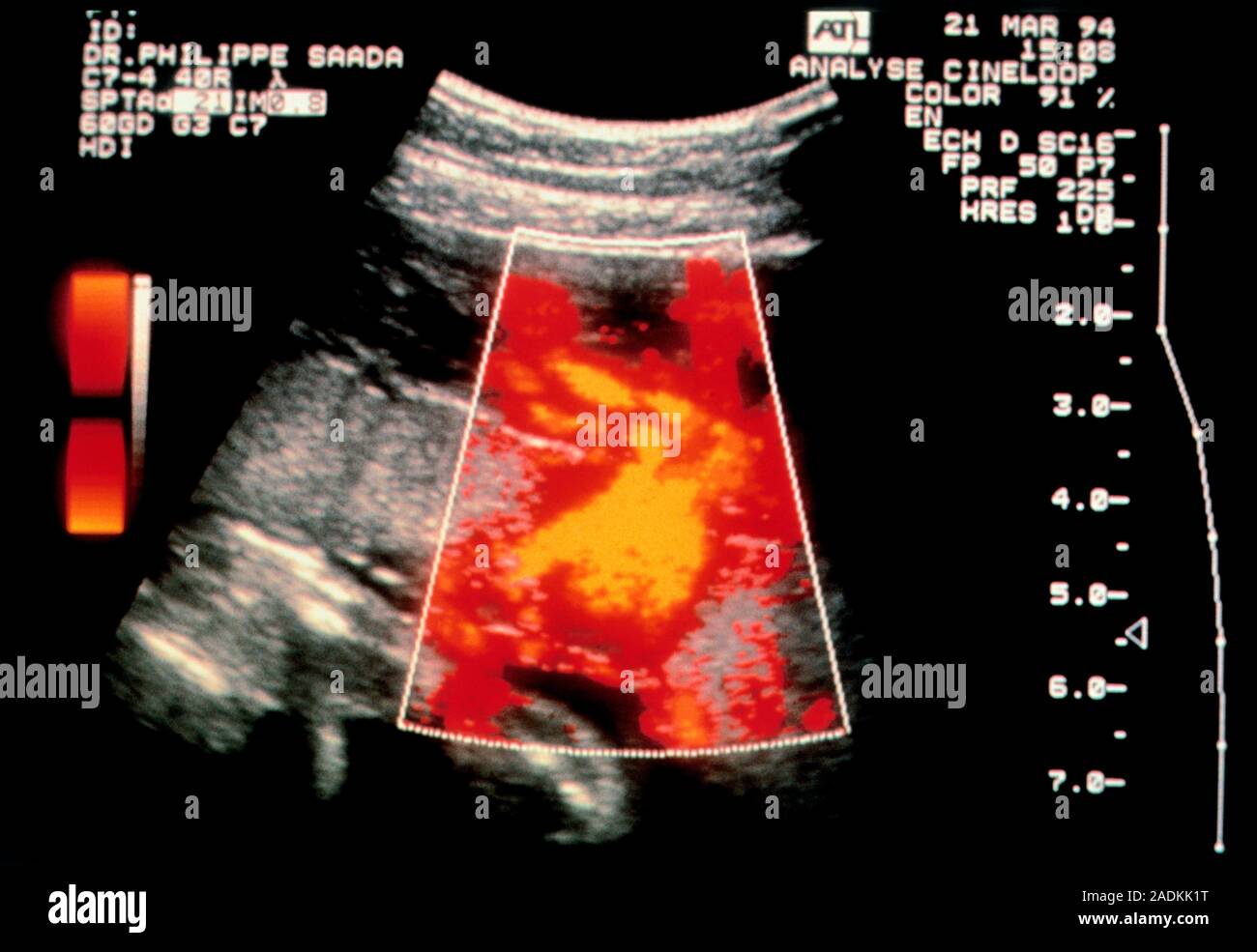 Blood Flow Through The Placenta Colour Doppler Ultrasound Scan Showing 