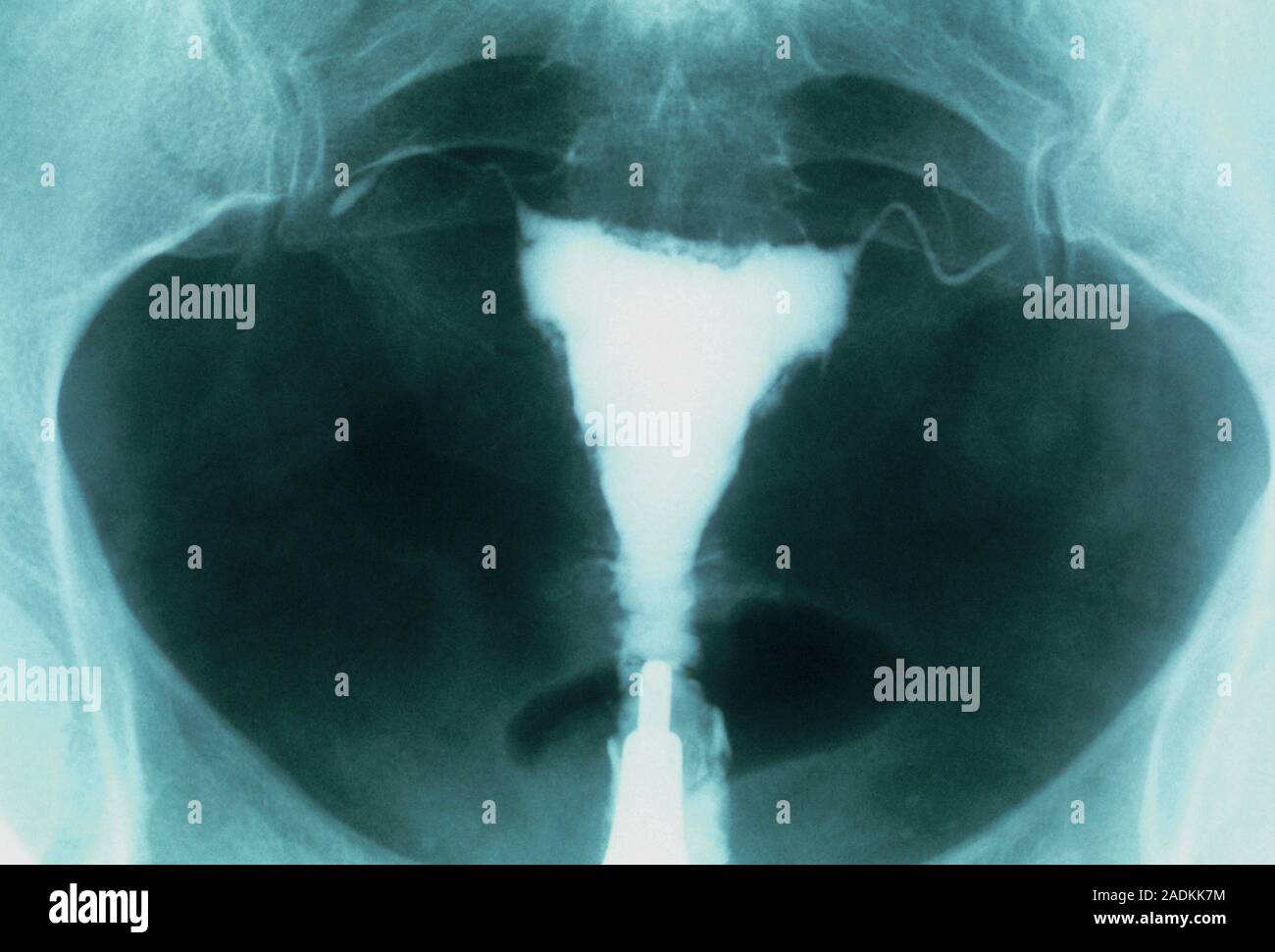 Postmenopausal uterus. Xray of the uterus (white, centre) of a post