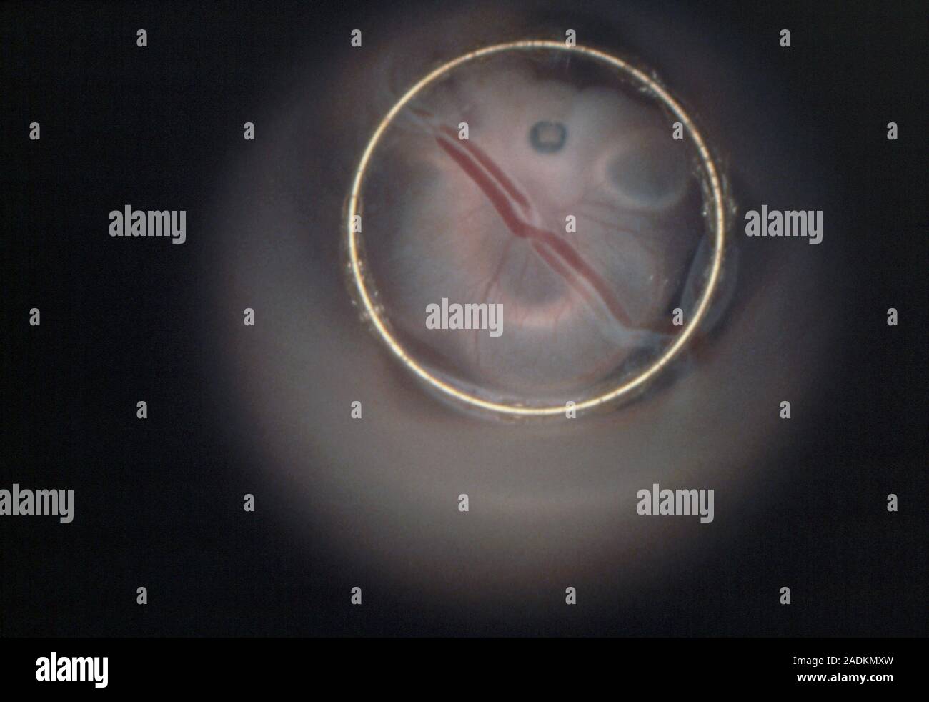 Endoscopic image of the human embryo in vivo after 4 weeks, showing the retina of the eye (dark