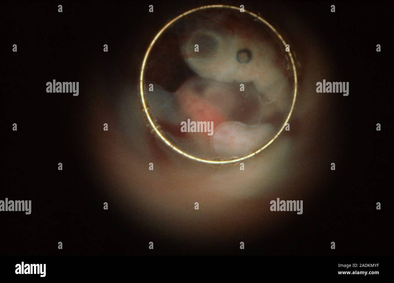 Endoscopic image of the human embryo in vivo after 4 weeks, showing the retina of the eye (dark