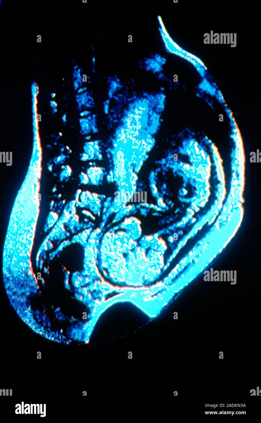 Falsecolour nuclear resonance (NMR) image showing a lateral