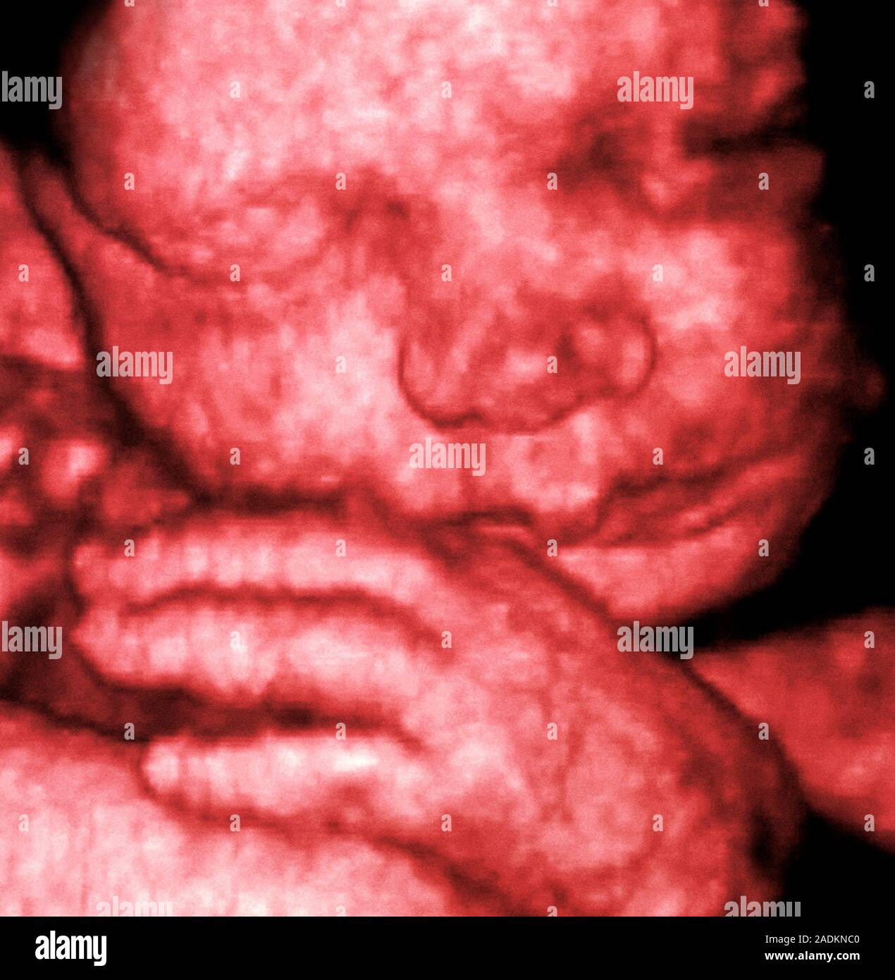 3D foetal ultrasound. Coloured threedimensional (3D) ultrasound scan