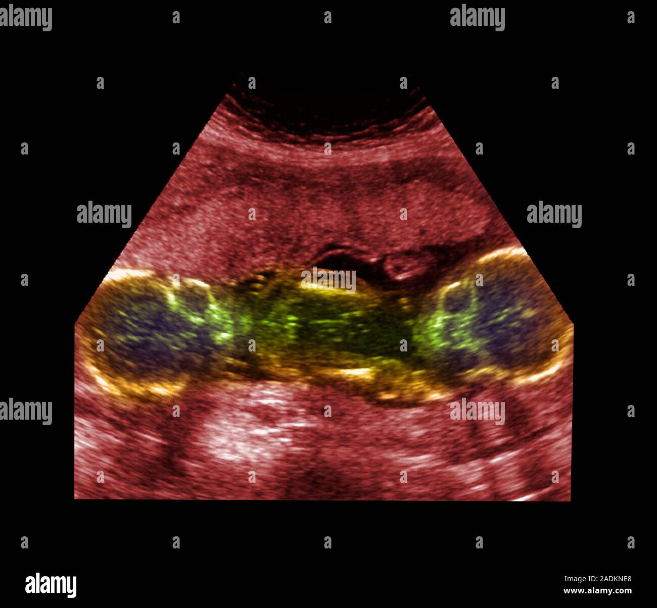 Twin foetuses. Coloured ultrasound scan of twin foetuses (green ...