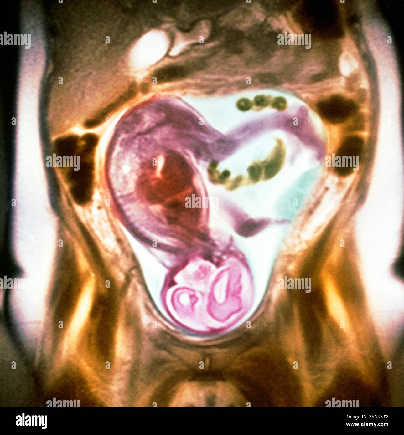 Foetus. Coloured resonance imaging (MRI) scan of a foetus