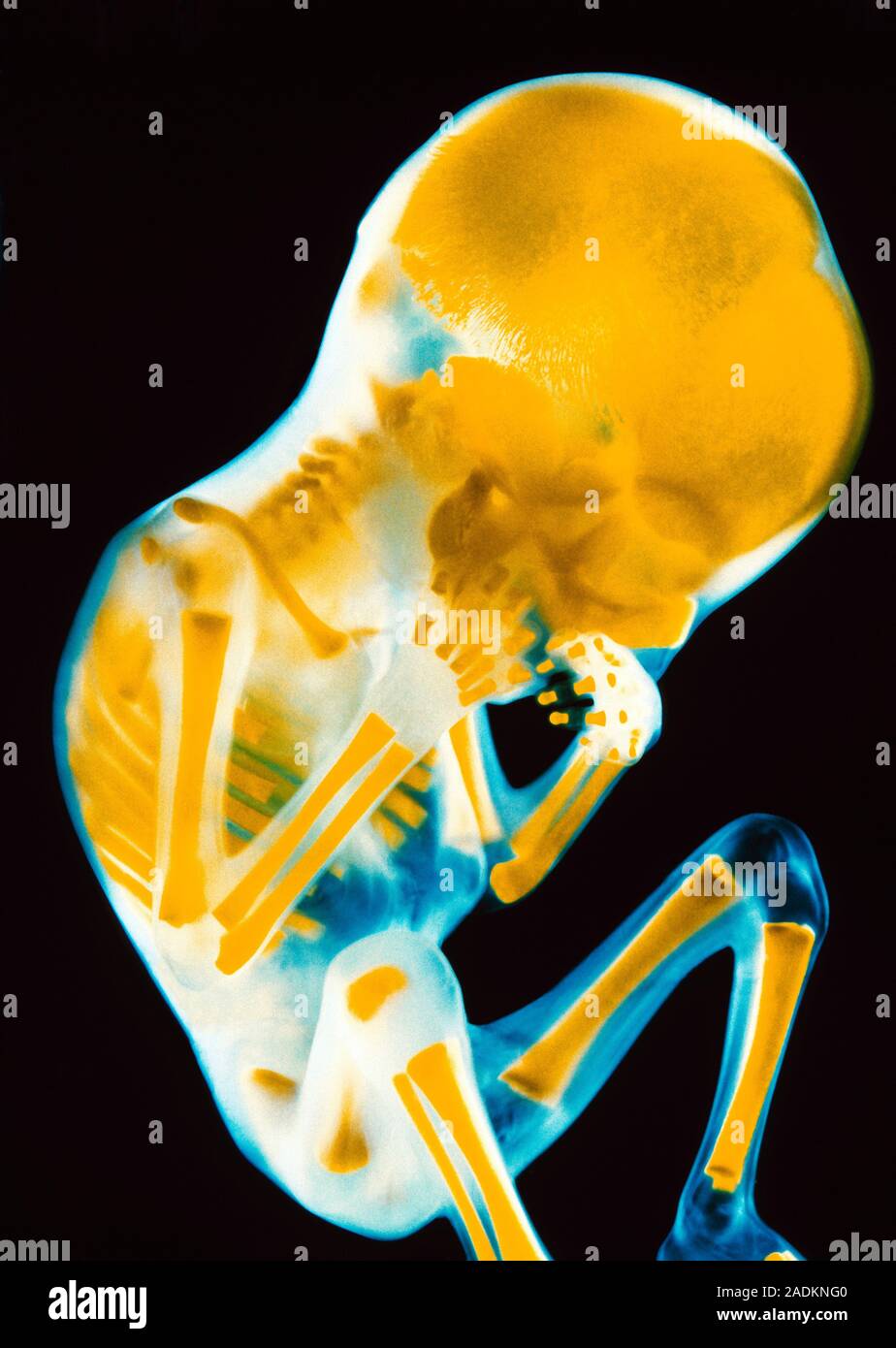 Foetus. Skeleton of a 16 week old human foetus. Hardened bone appears yellow here. Gaps between the ends of bones, such as the fingers, are filled wit Stock Photo
