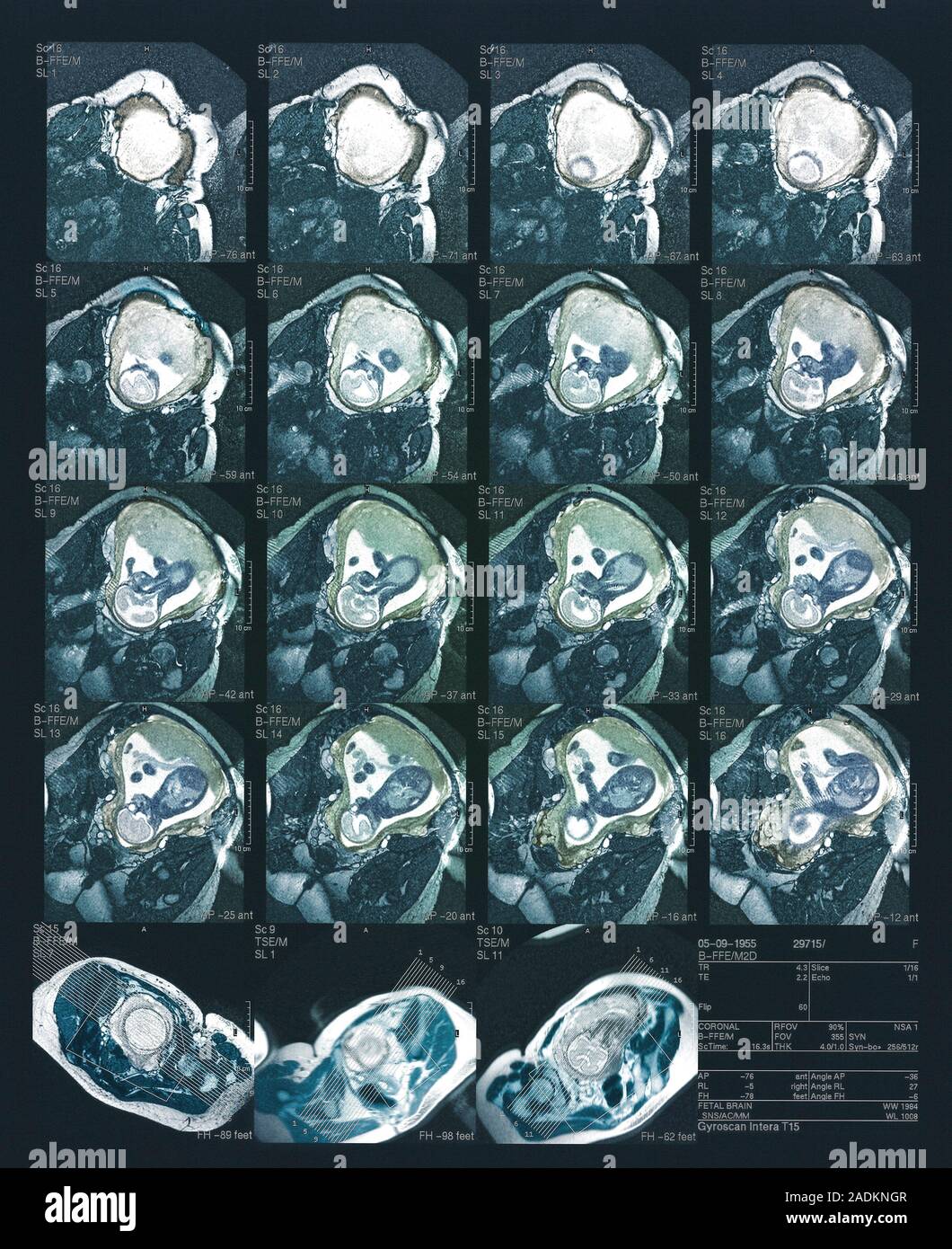 Foetus at 27 weeks, sequence of coloured magnetic resonance imaging ...