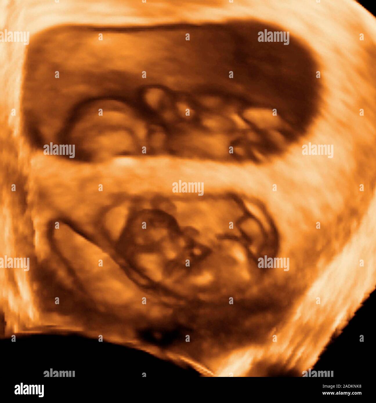 Twin foetuses. Coloured 3D ultrasound scan of twin foetuses. Non