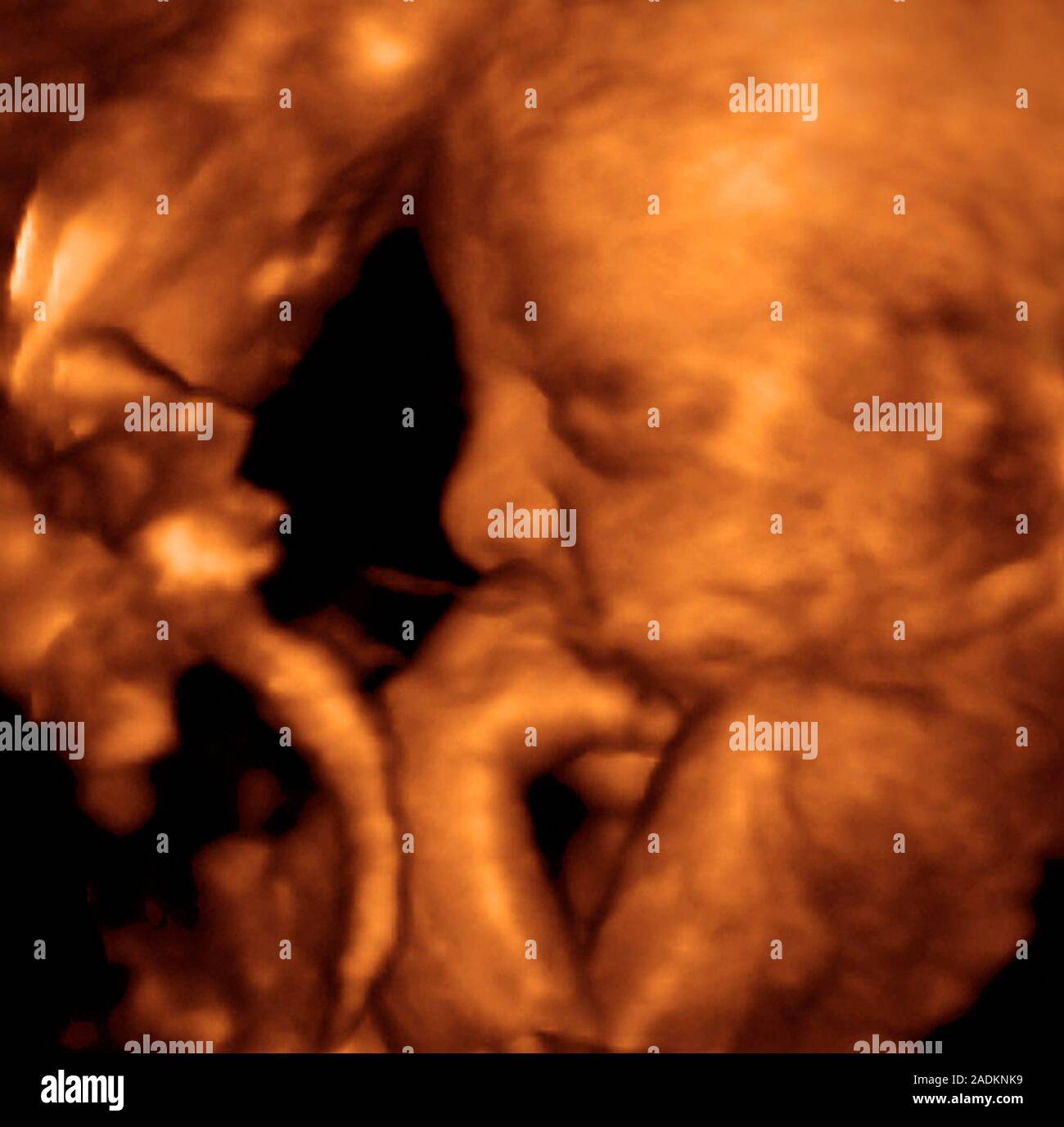 Foetus. Coloured 3-D ultrasound scan of the face, shoulder and forearm ...