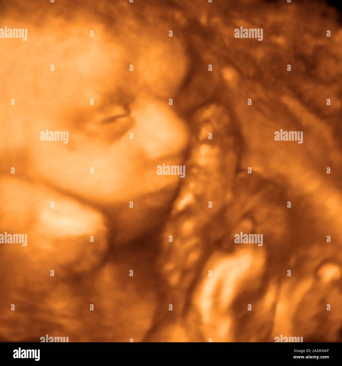 Foetus. Coloured 3-D ultrasound scan of the face of a foetus in profile ...