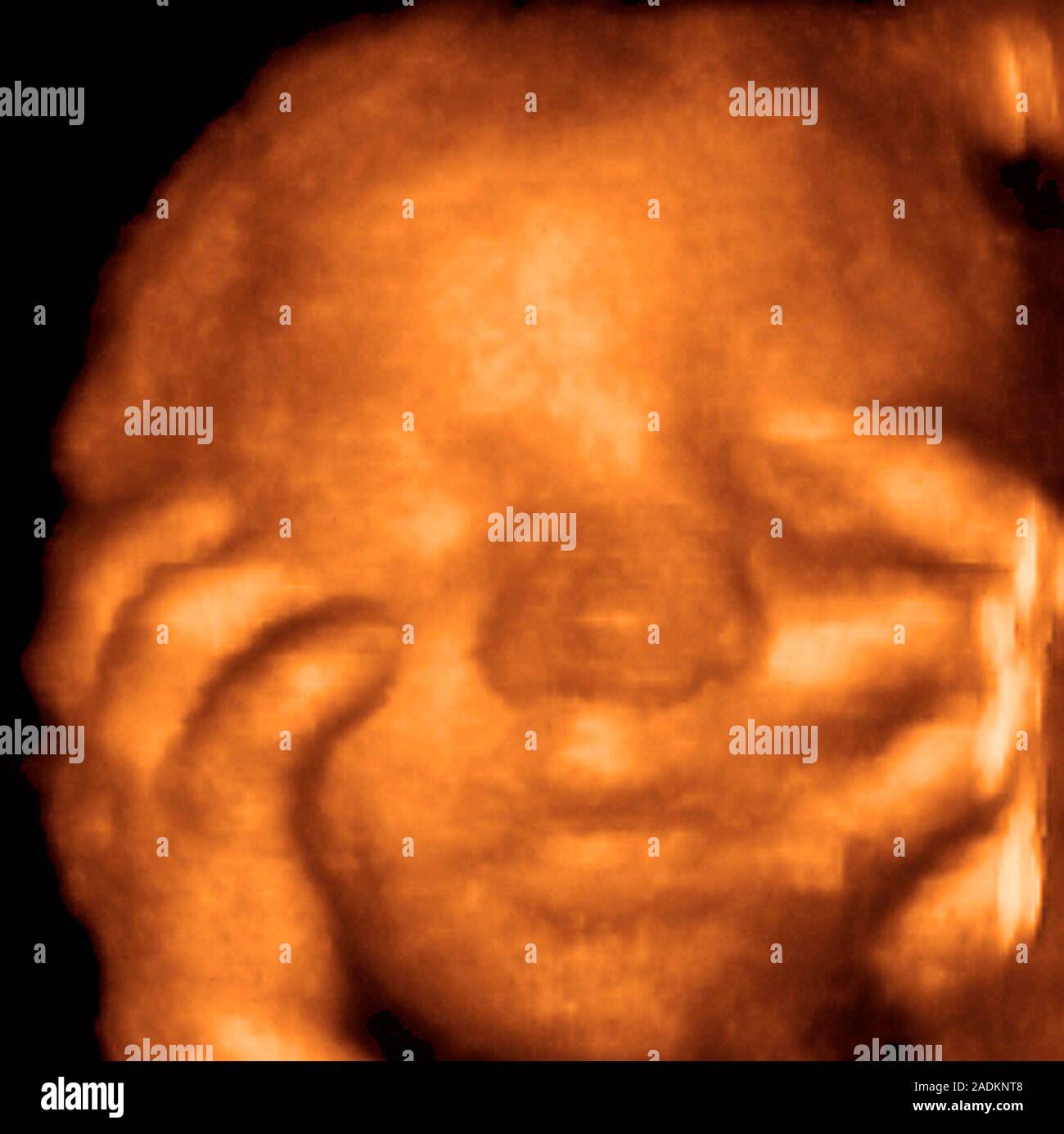 Foetus's face. Coloured 3-D ultrasound scan of a foetus holding its ...