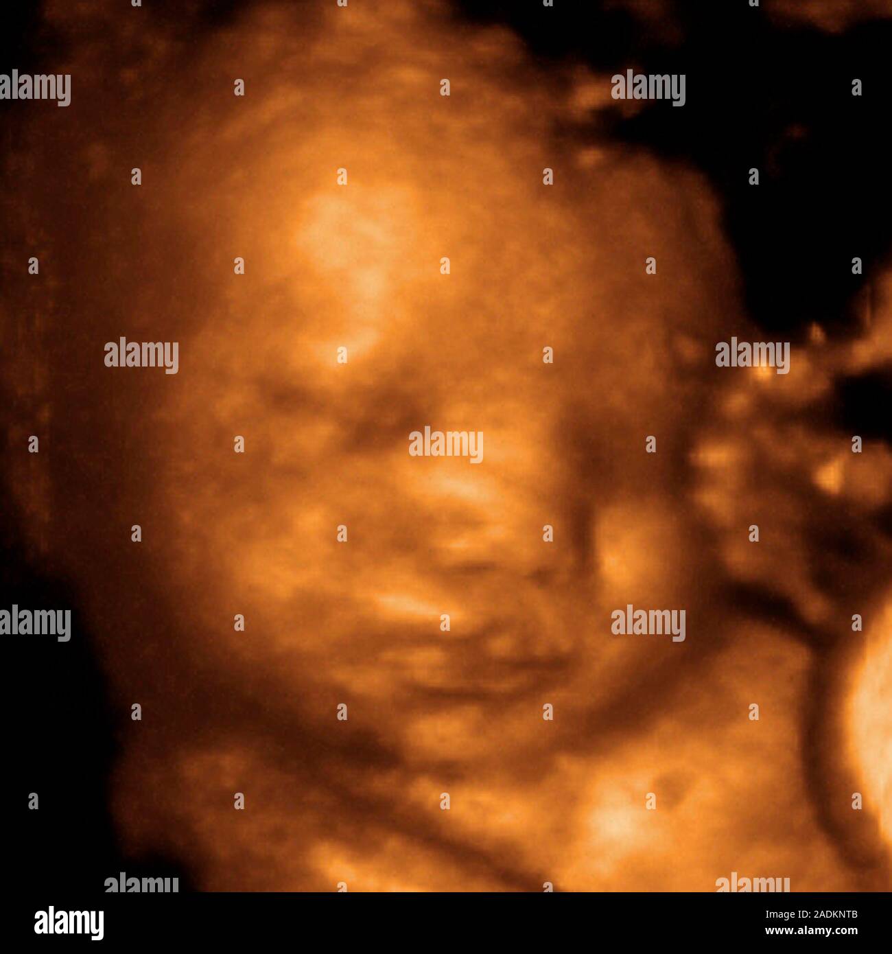 Foetus's face. Coloured 3-D ultrasound scan of a foetus' face looking ...
