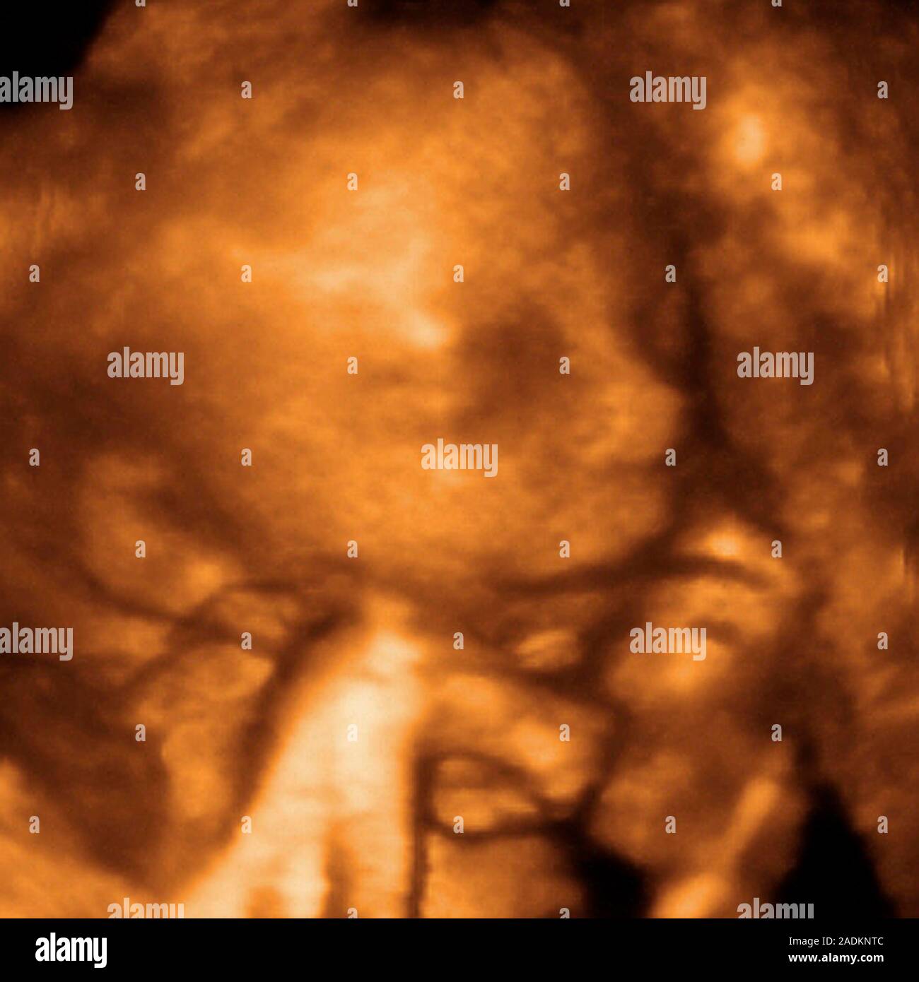 Foetus's face. Coloured 3-D ultrasound scan of a foetus holding its ...