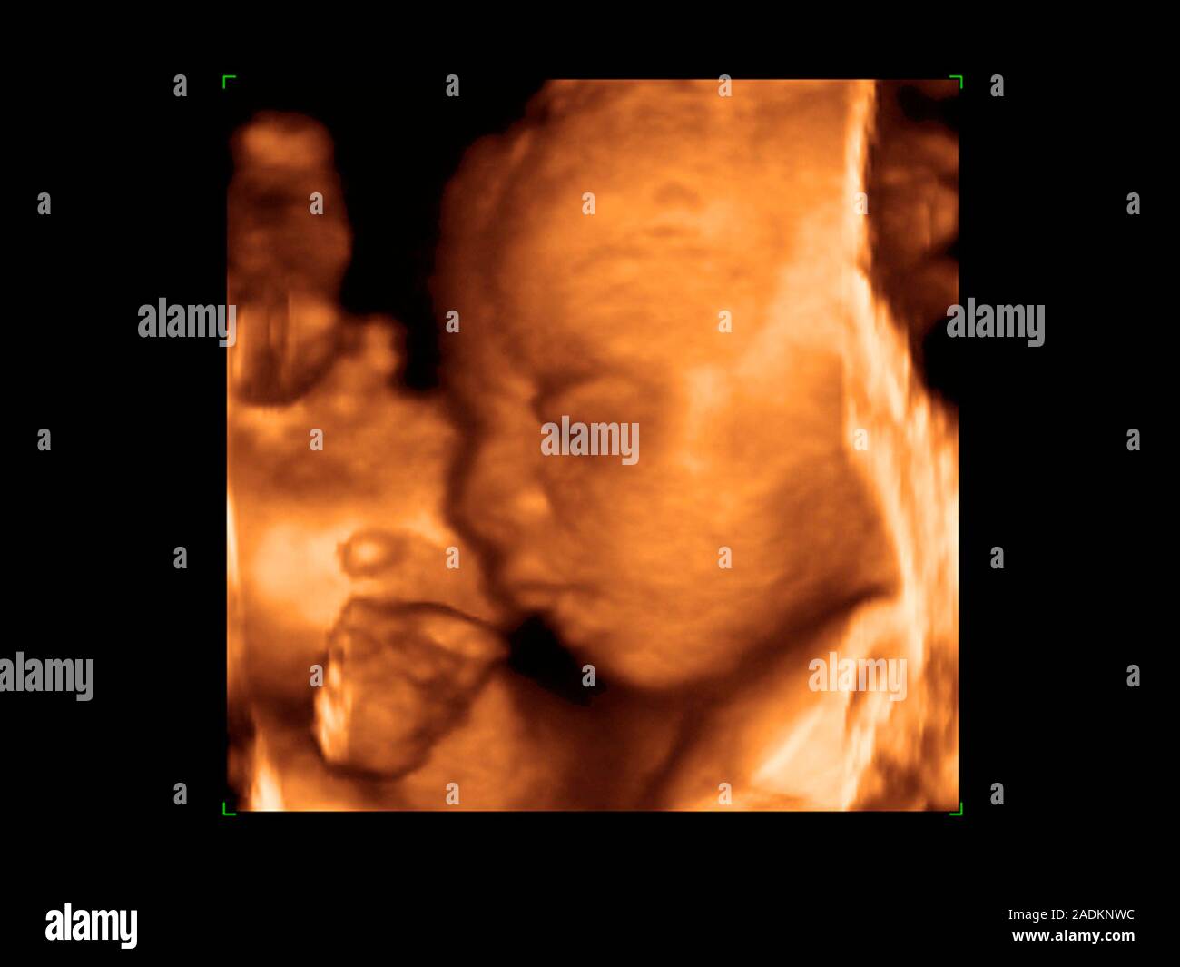 Foetus' face. Coloured 3-D ultrasound scan of a foetus' face in profile ...