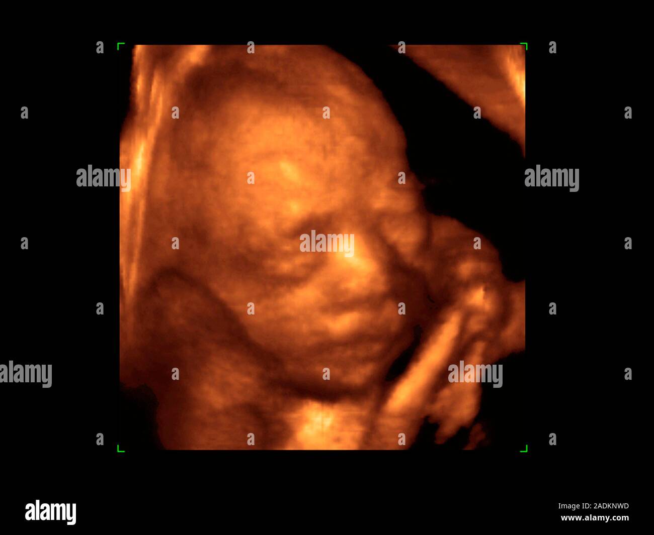 Foetus' face. Coloured 3-D ultrasound scan of a 25 week old foetus ...