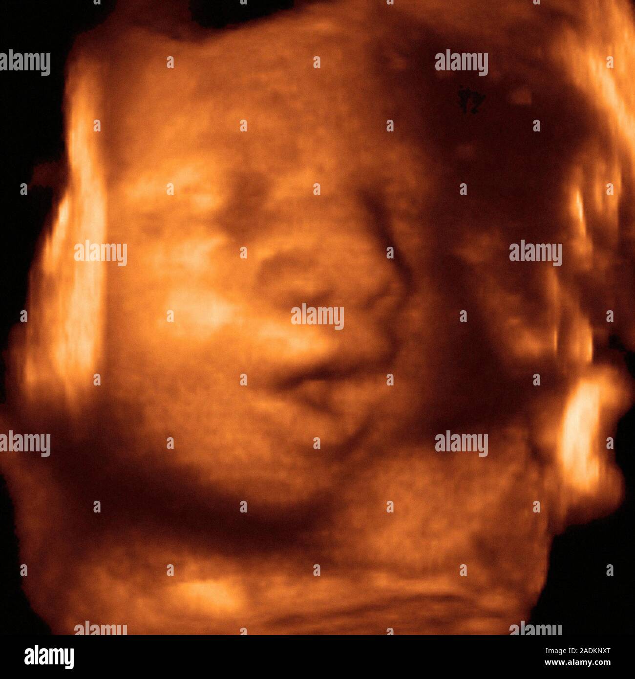 Foetus' face. Coloured 3-D ultrasound scan of a foetus' face. The foetus'  nose is at centre and the mouth, which is open, is below it. Ultrasound  scan Stock Photo - Alamy, image size:1300x1390