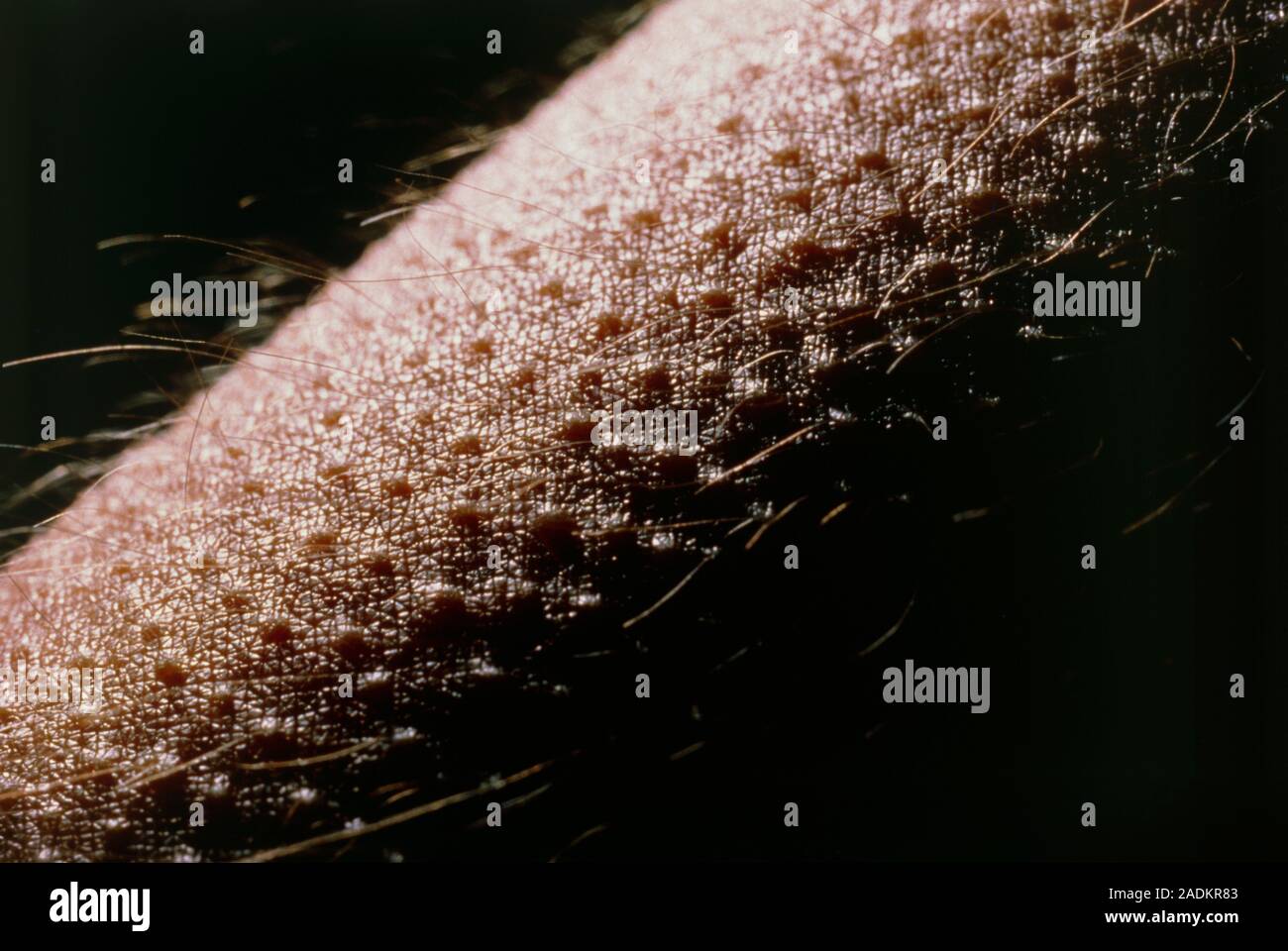 Closeup of the human forearm showing goose bumps (medical name cutis anserina), a reaction of