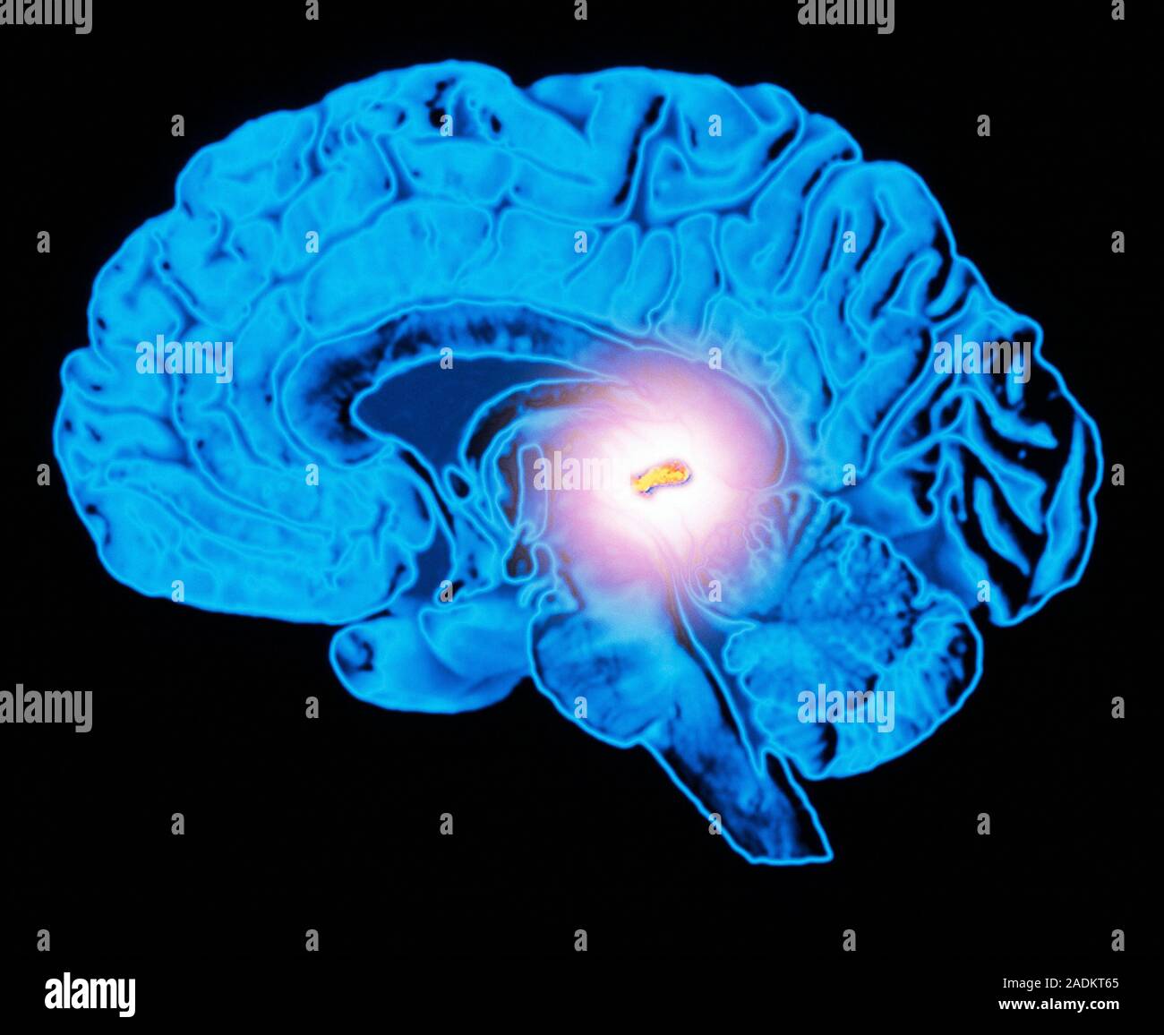 Pineal gland. Computer artwork of a sectioned human brain in side view ...