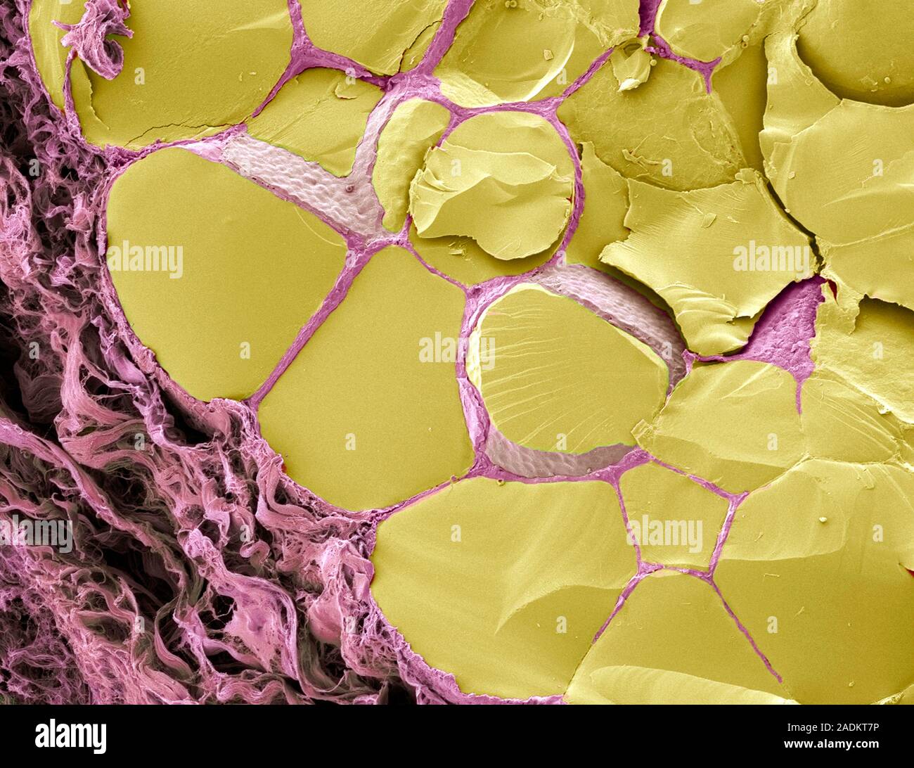 Thyroid gland. Coloured scanning electron micrograph (SEM) of a fracture through the thyroid gland revealing several follicles (yellow). Between the f Stock Photo
